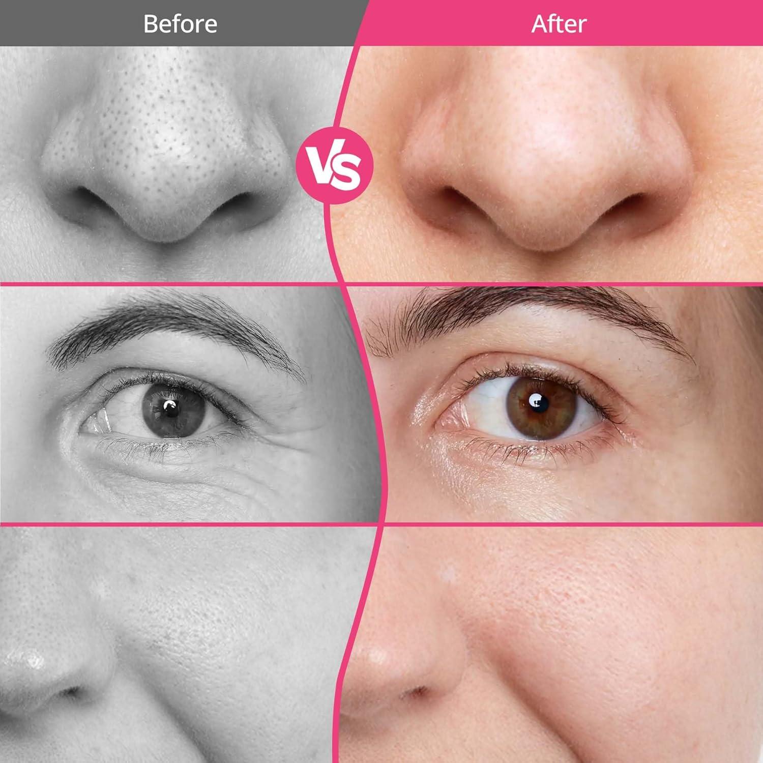 Máquina de Microdermoabrasi&oacute;n UNOISETION Rosa Portátil 12 Puntas