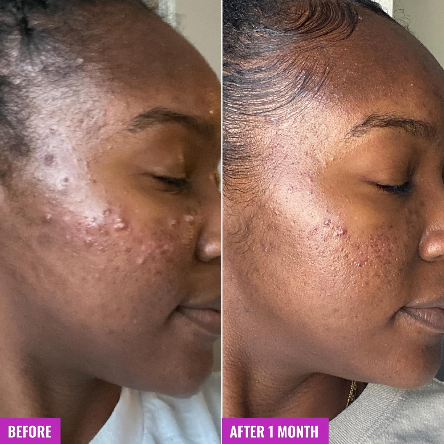 Limpiador Espumoso Good Molecules 148ml con Ácido Salicílico