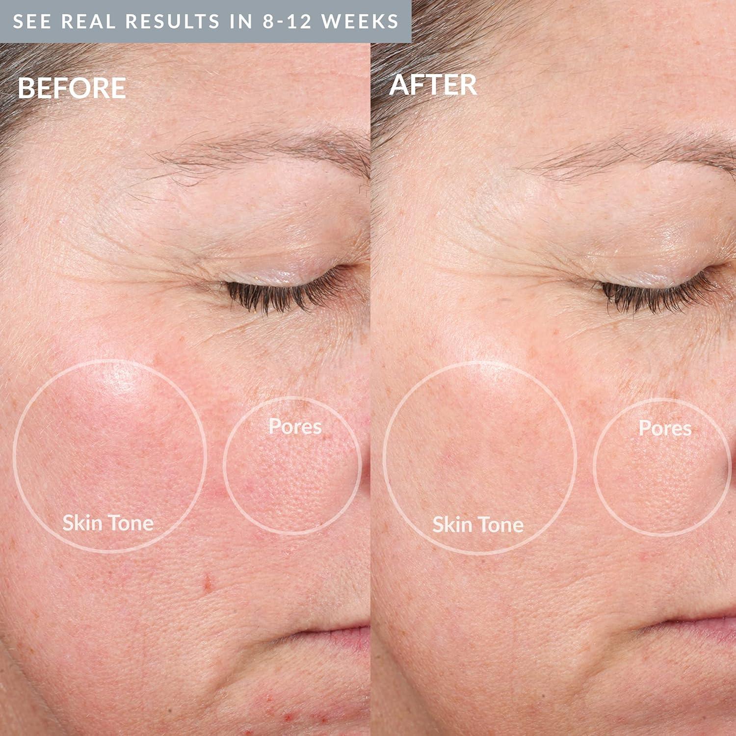 Exfoliador Facial PMD Beauty Personal Microderm Elite Pro - Kit de Microdermoabrasión