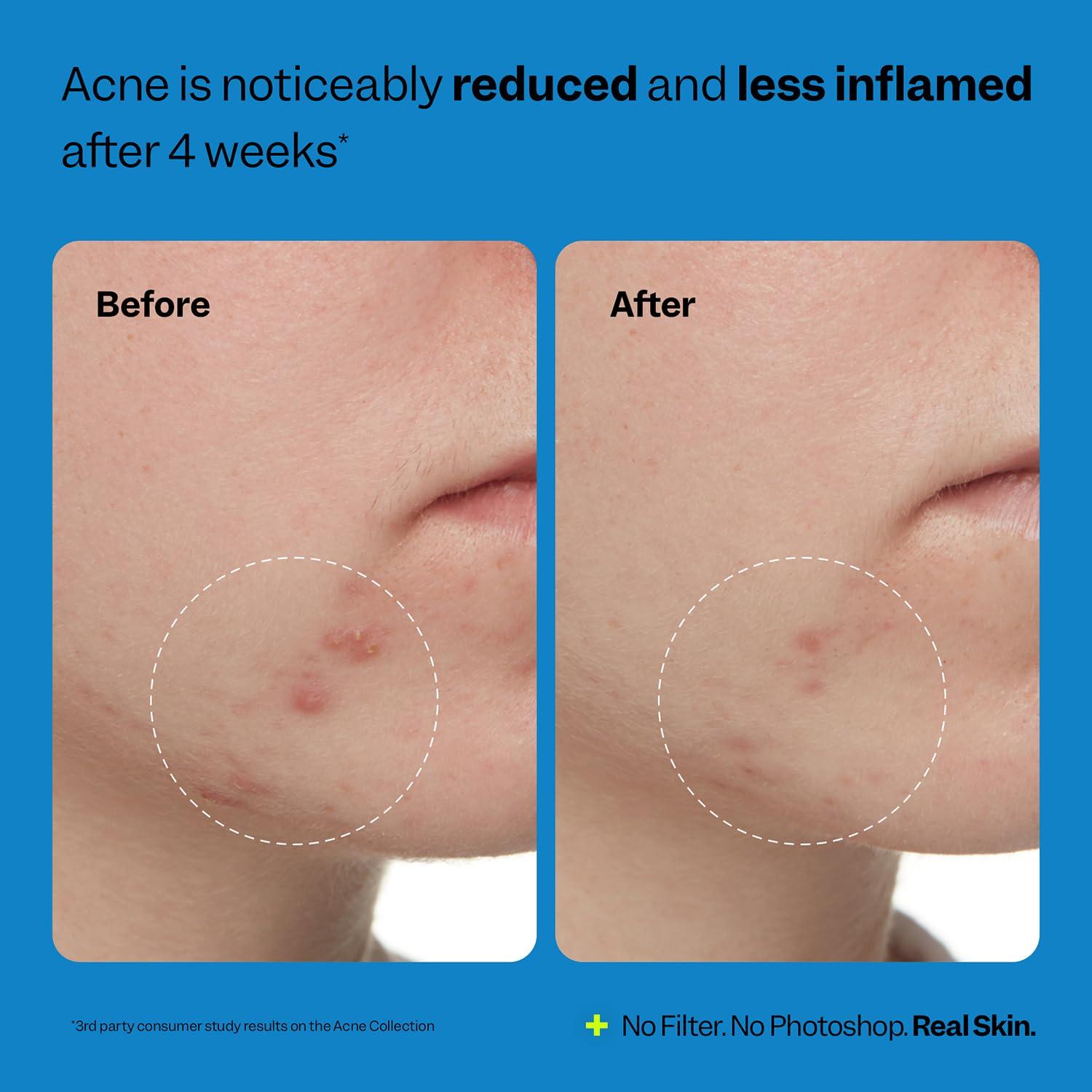 Kit de Cuidado de Piel Peach & Lily - Acné 3 Pasos - Vegano