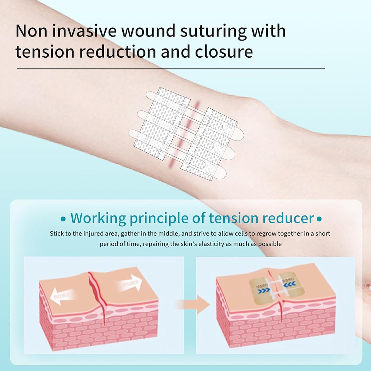 Kit de Cierre de Heridas Mariposa 6x8cm Vendas Autoadhesivas