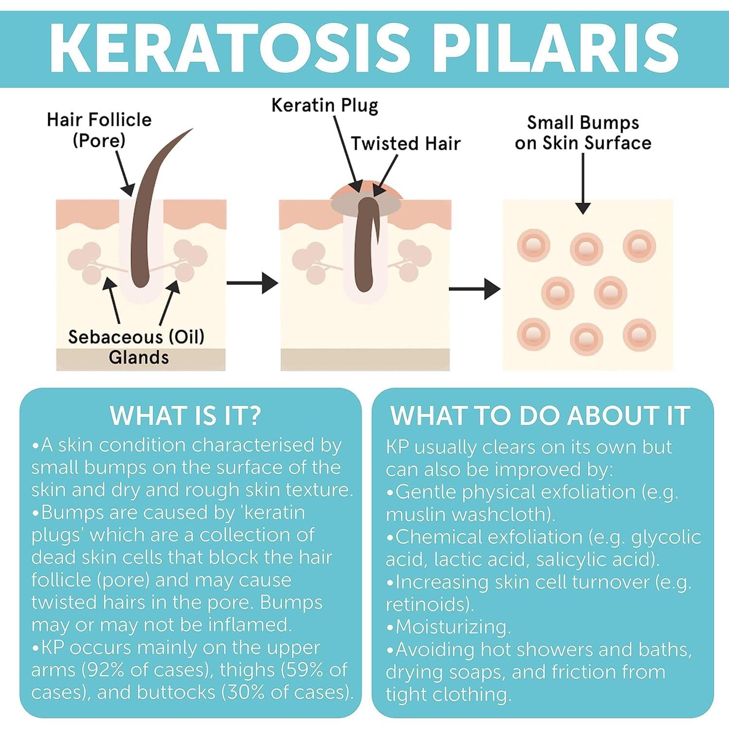 Loción Corporal Exfoliante KP 132g - Tratamiento Queratosis Pilaris