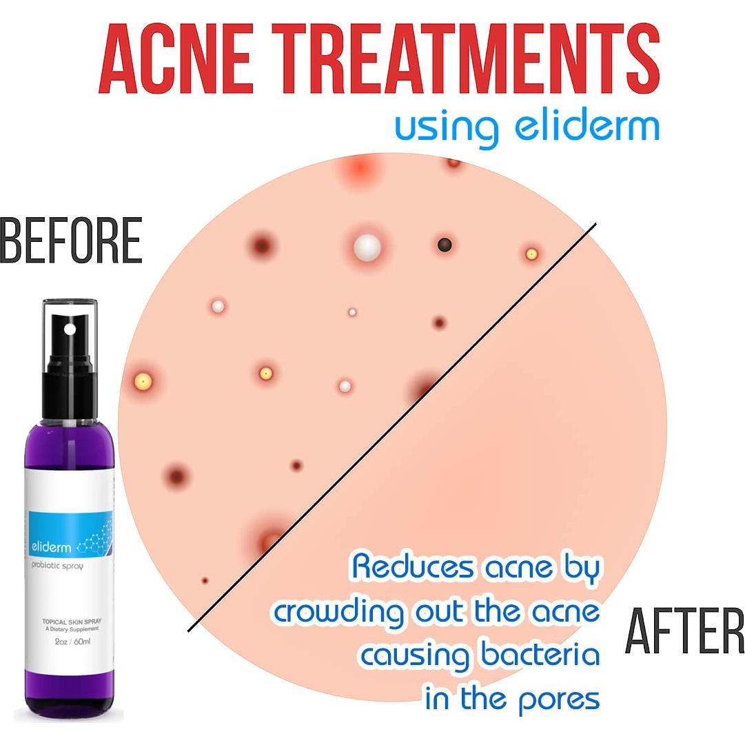 Spray Probiotico Eliderm para Piel - 13 Cepas Vivas 45g