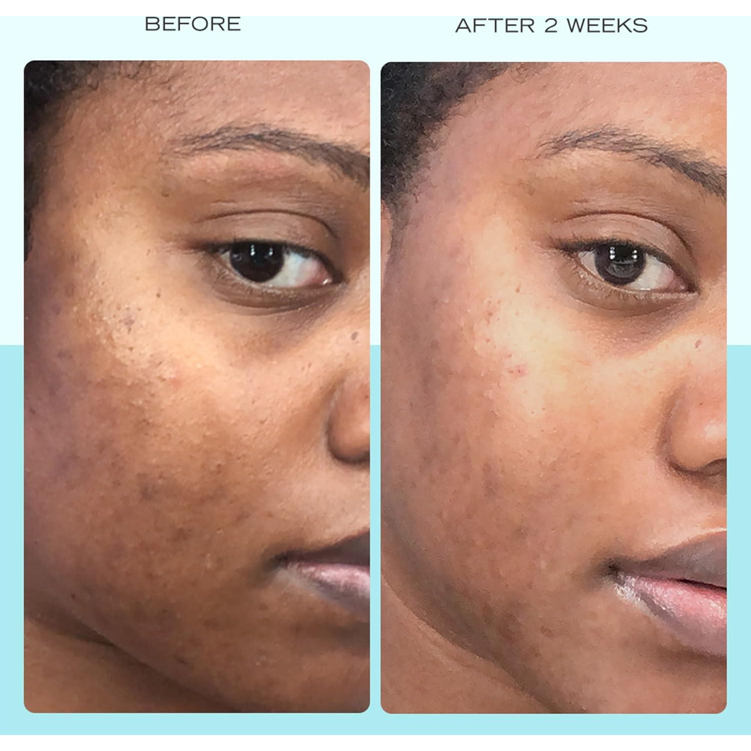 Suero para Manchas Oscuras First Aid Beauty 29.57 ml Niacinamida