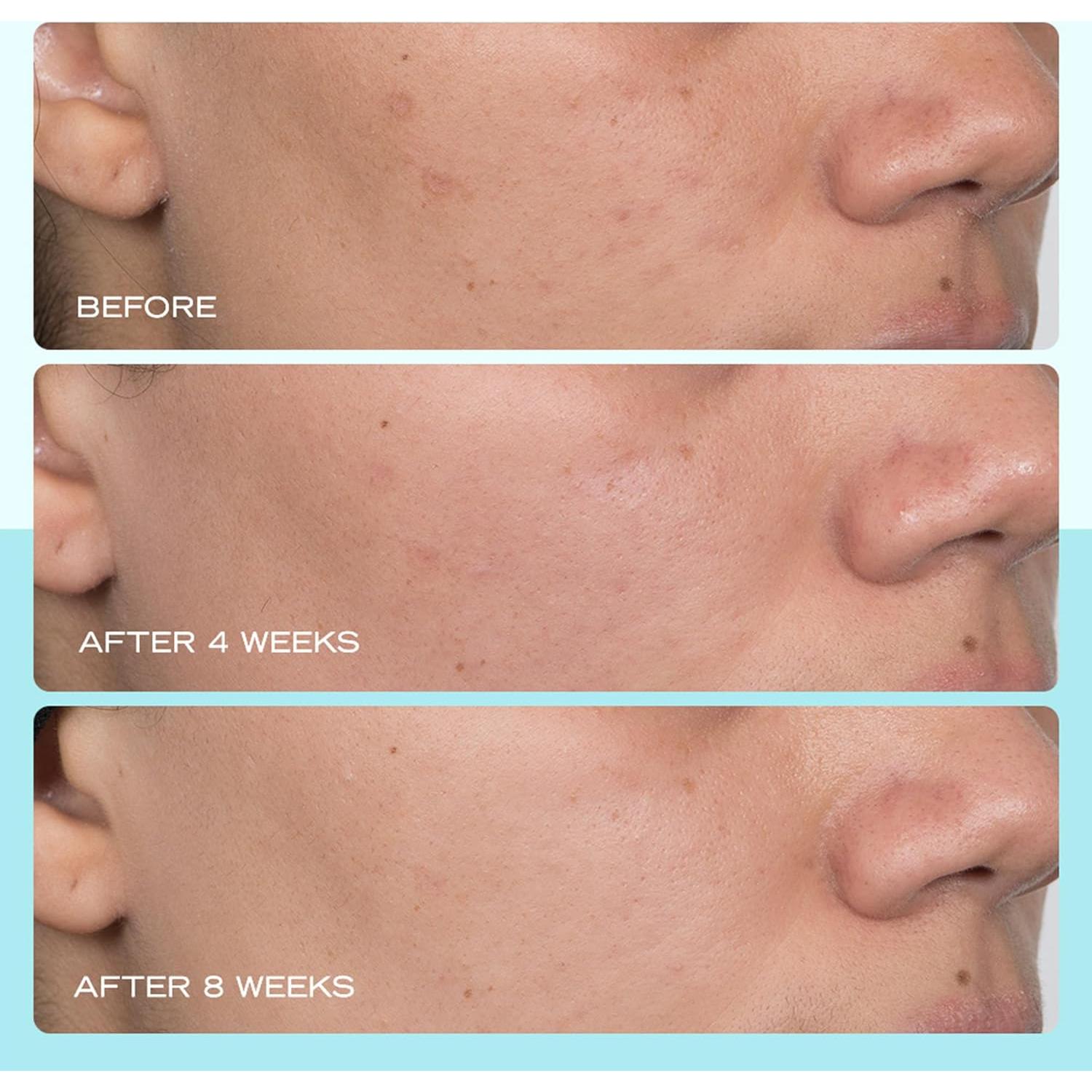 Suero para Manchas Oscuras First Aid Beauty 29.57 ml Niacinamida