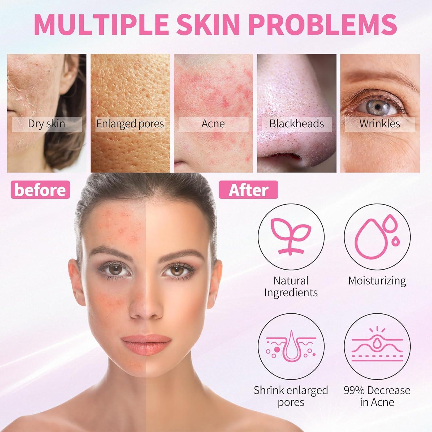 Kit de Cuidado Facial LXSKN 5 Pasos para Acné - Hidratante y Exfoliante