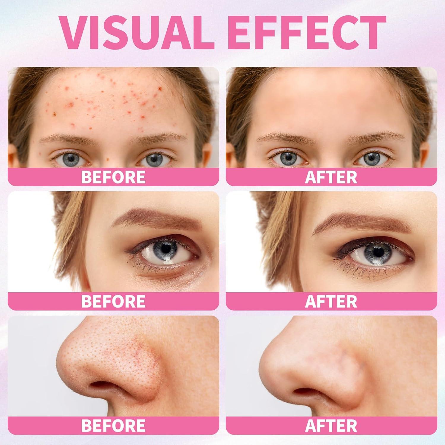 Kit de Cuidado Facial LXSKN 5 Pasos para Acné - Hidratante y Exfoliante