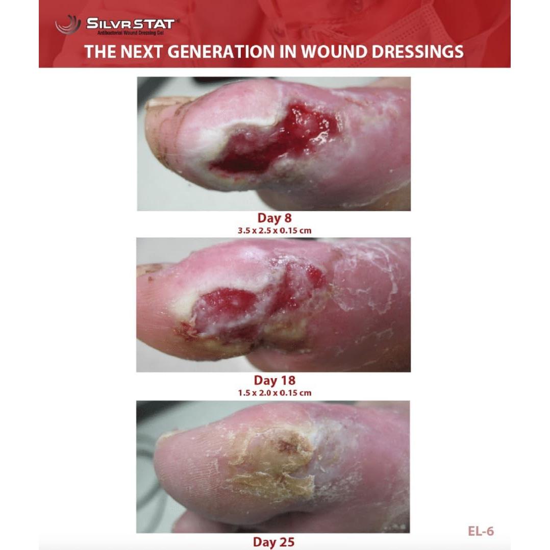 SilvrSTAT Gel de Vendaje de Heridas con Plata 28.35 g
