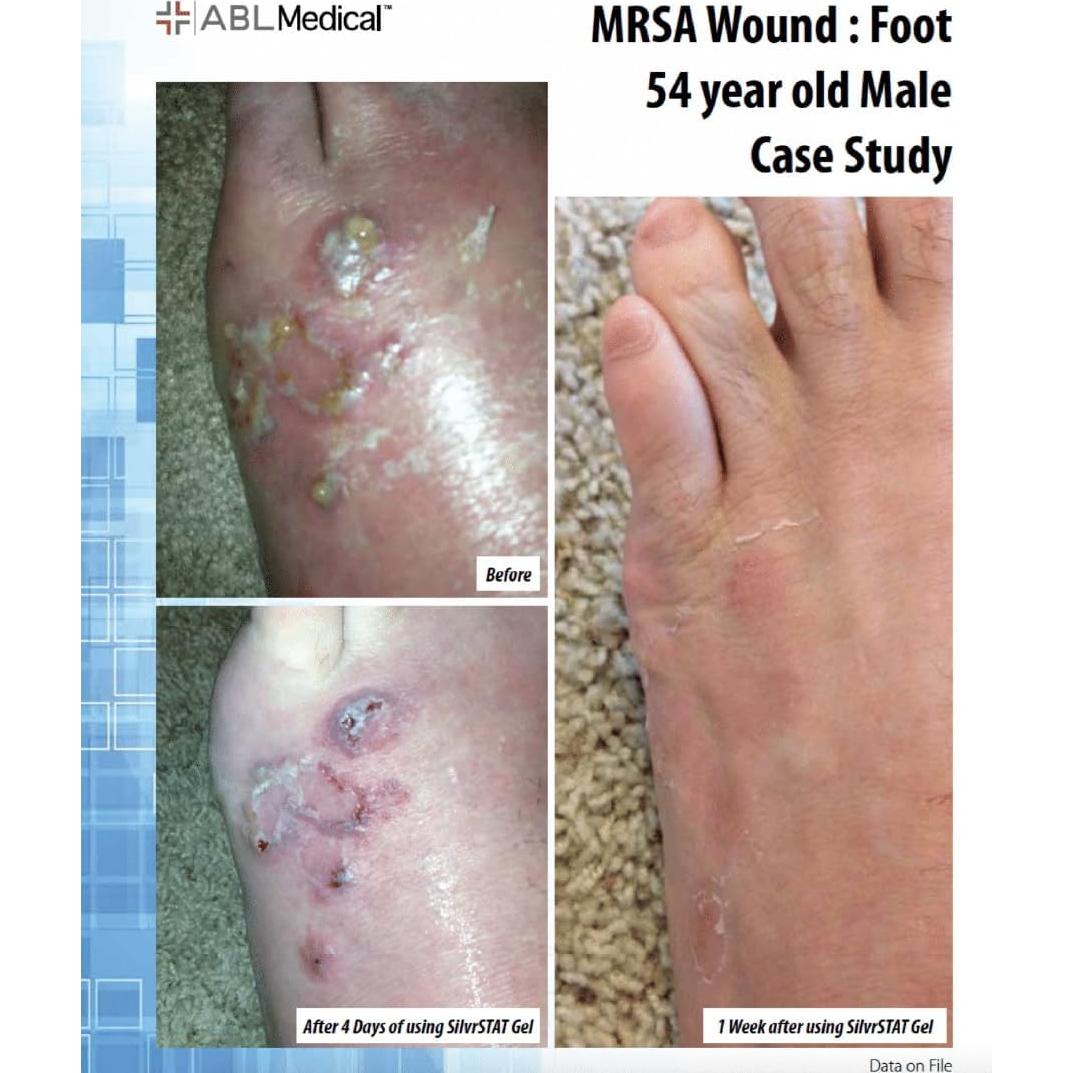 SilvrSTAT Gel de Vendaje de Heridas con Plata 28.35 g