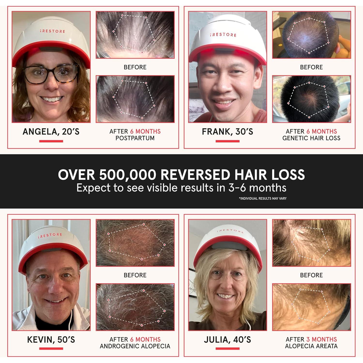 iRestore Pro Gorro Terapia Luz Roja 282 Lásers Crecimiento Cabello