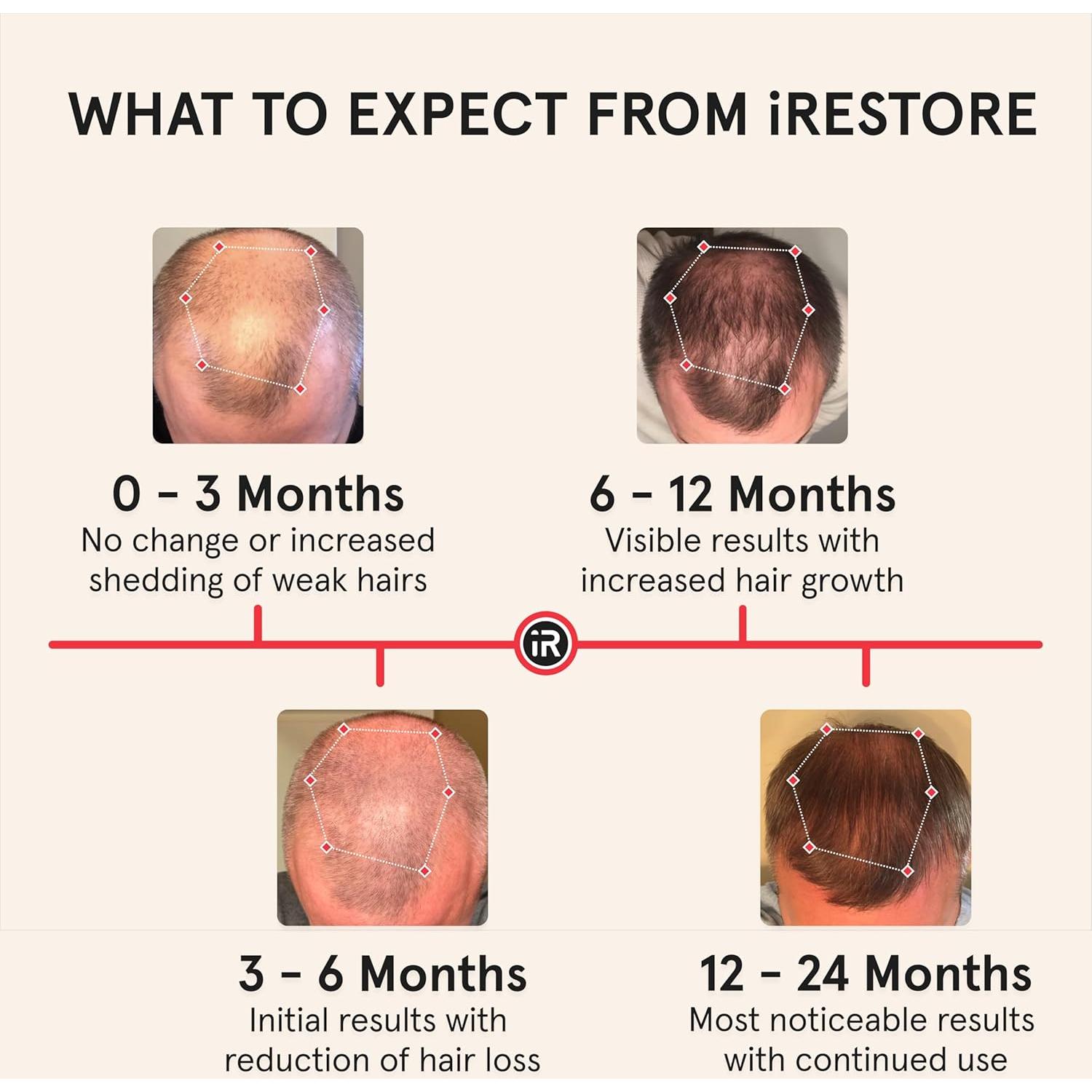 iRestore Pro Gorro Terapia Luz Roja 282 Lásers Crecimiento Cabello