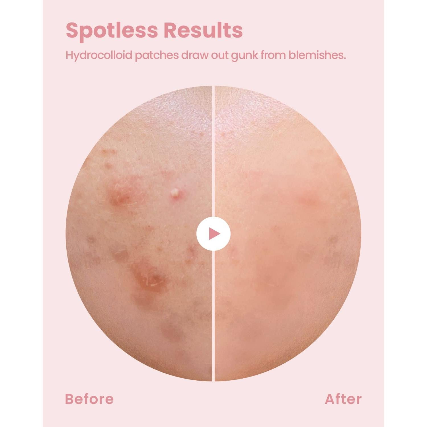 Parches para Granos Hydrocolloid Glam Up 180 Piezas 10mm/12mm