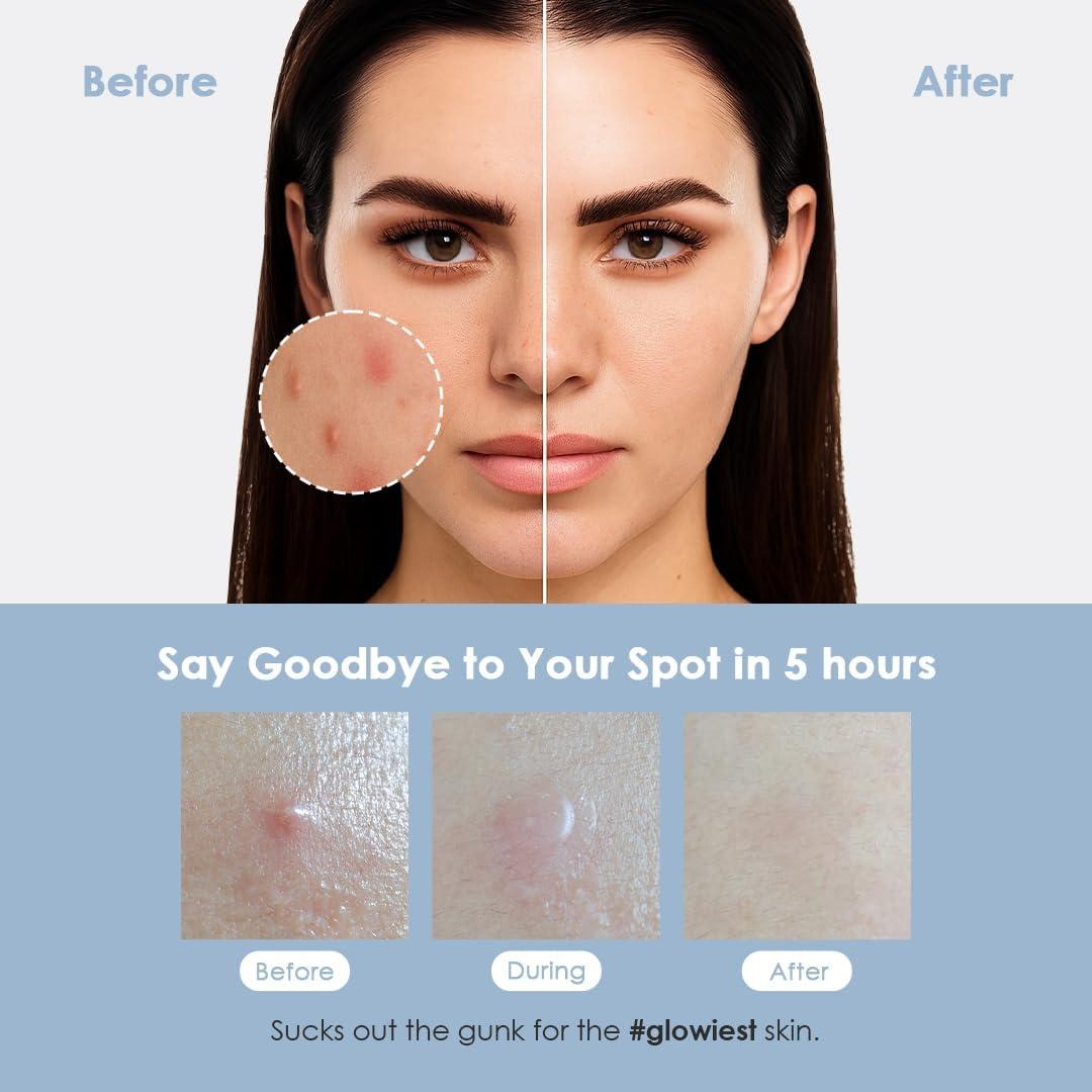 Parche Hidrocoloide ASAP Glowiest para Granos Activos - 52 Unidades