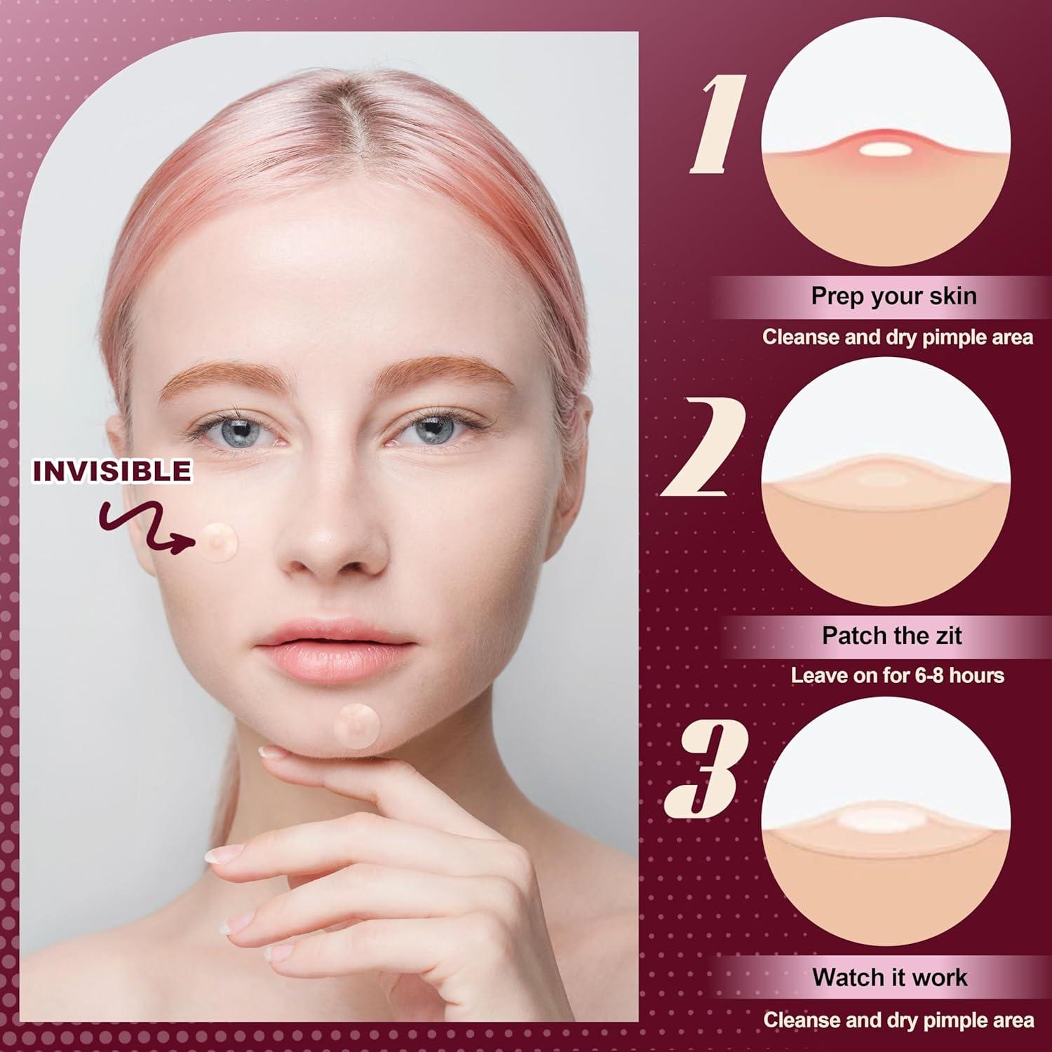 Parches para Granos Hidrocoloides Shivrise - 300 Unidades, 4 Tamaños