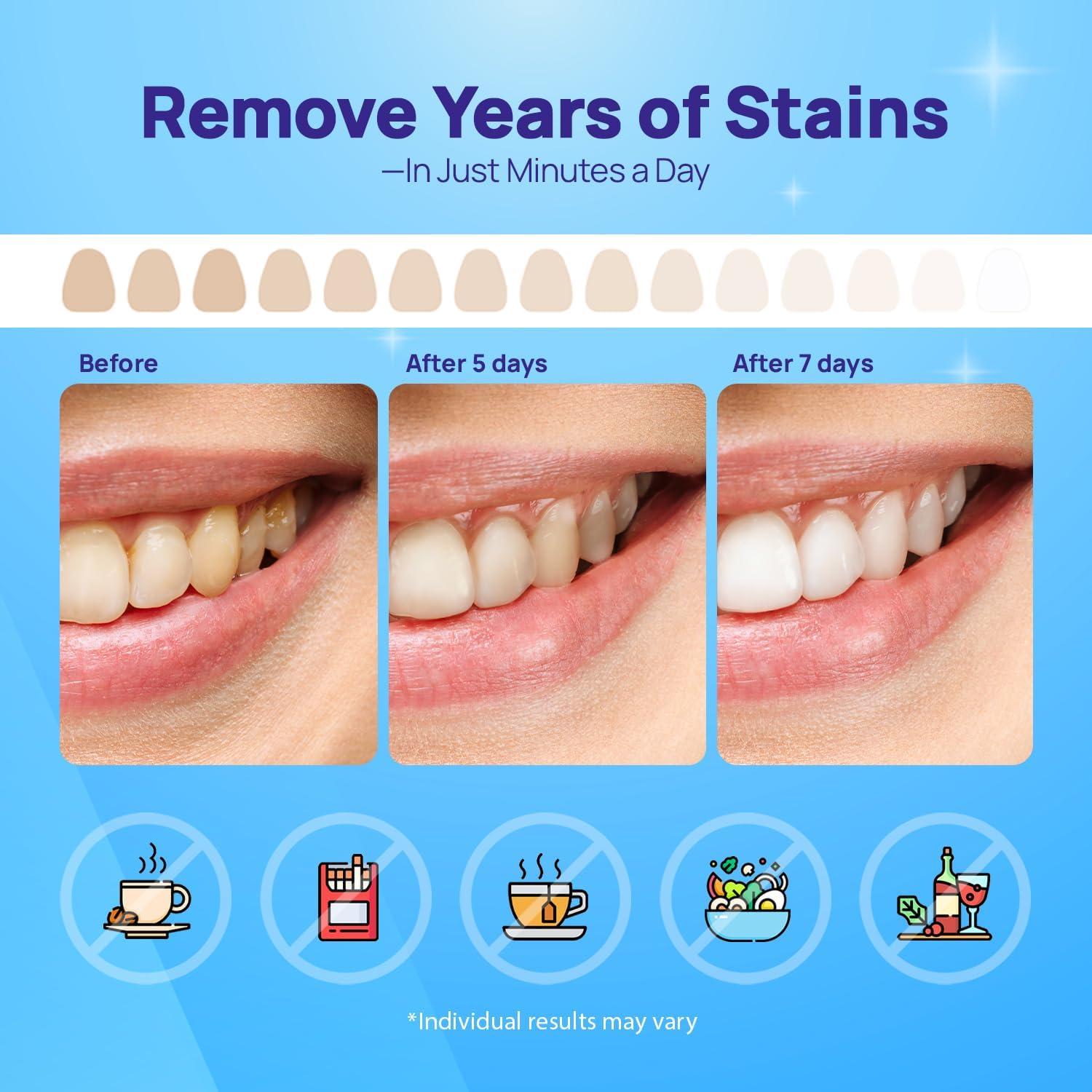 Tiras Blanqueadoras de Dientes Whitebite Pro 28 Tiras