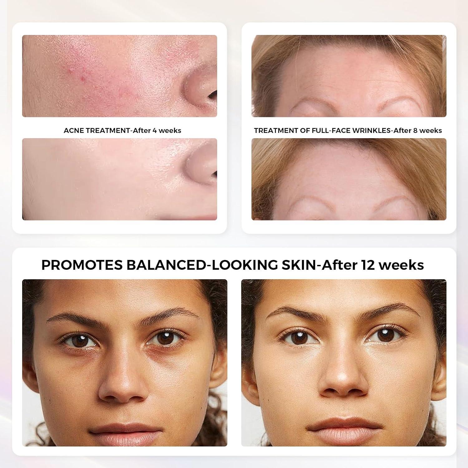 Máscara Facial LED 3D QuasarMD con Luz Roja y Azul para Piel Radiante