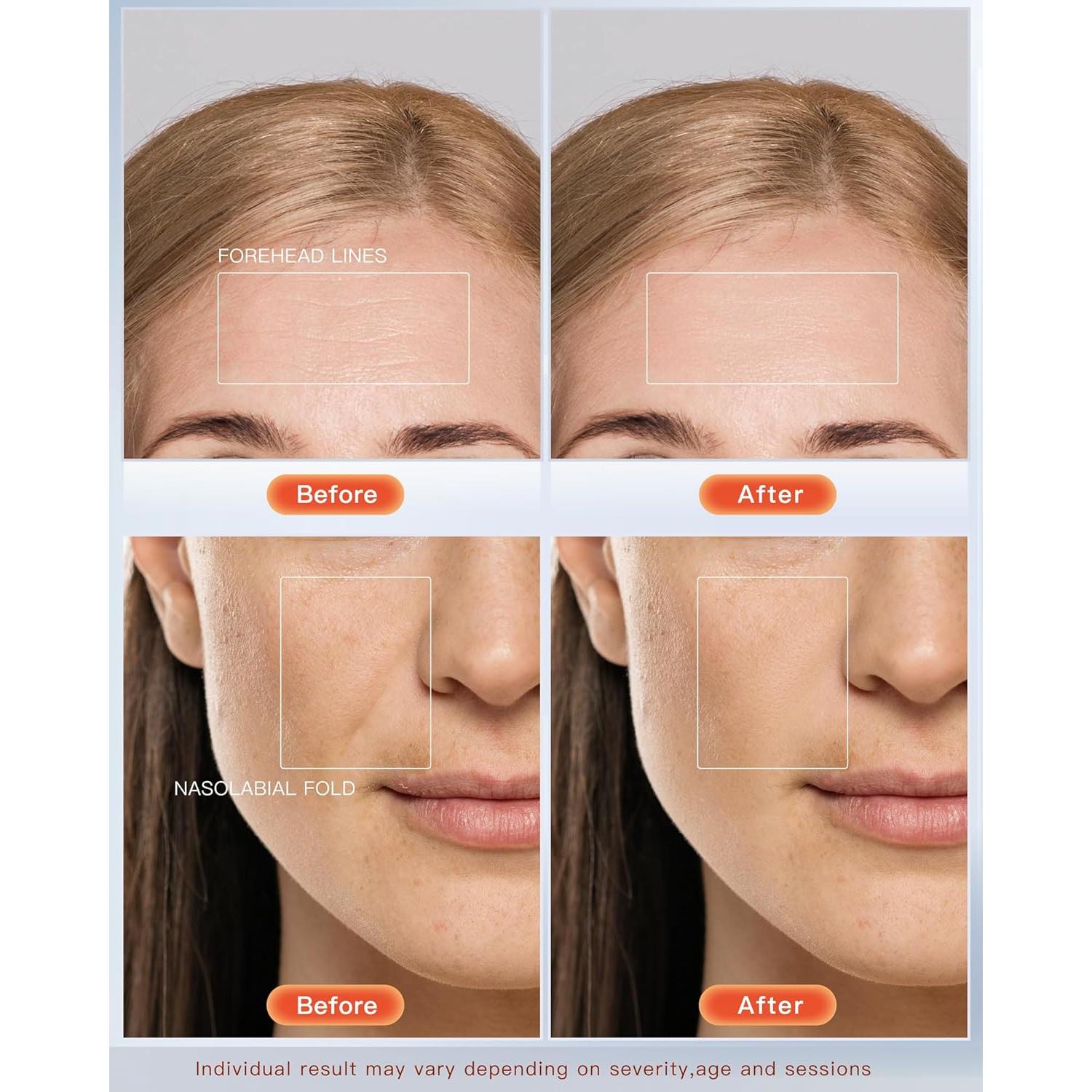 Máscara Facial LED NEWKEY Terapia Luz Roja y Azul 150 LEDs