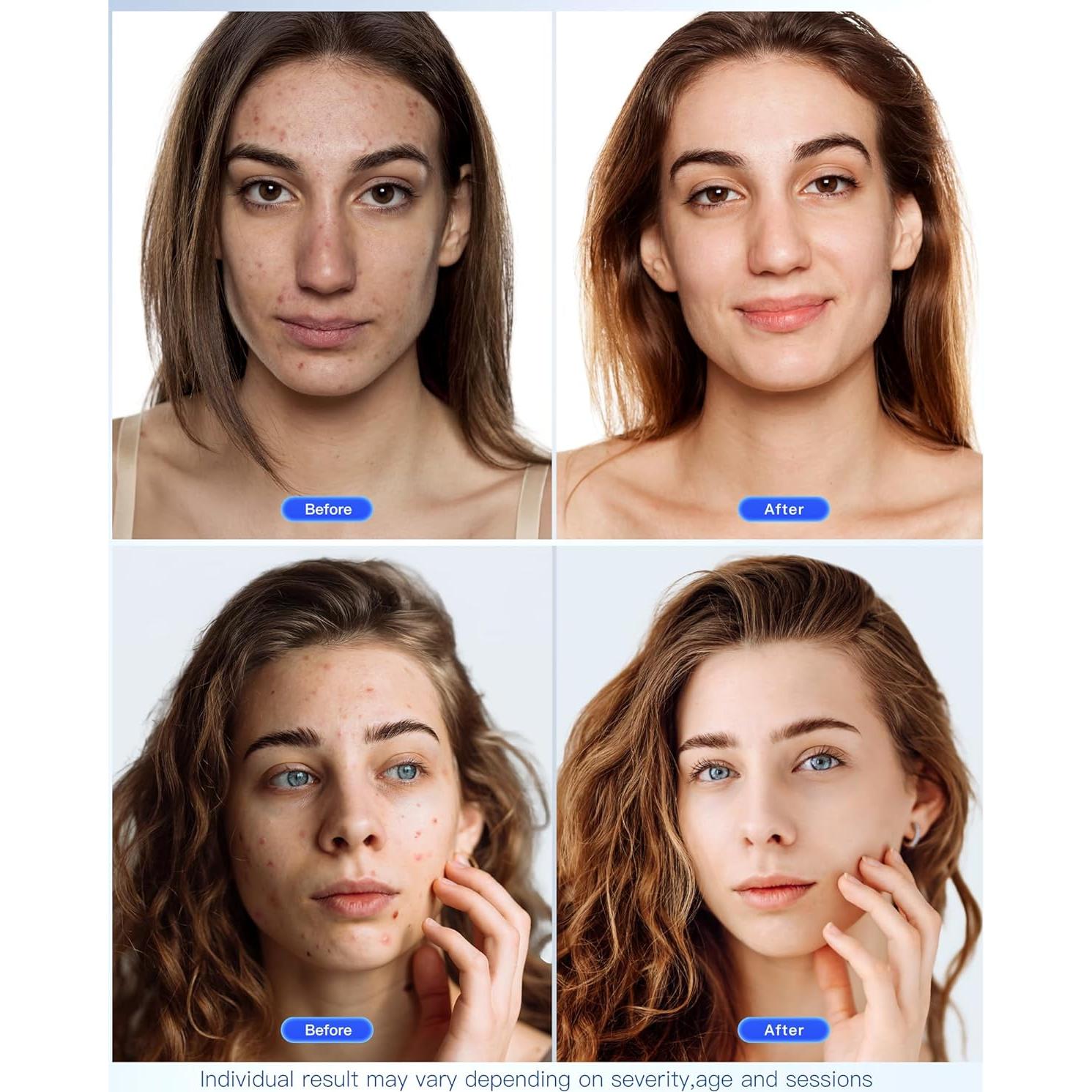 Máscara Facial LED NEWKEY Terapia Luz Roja y Azul 150 LEDs