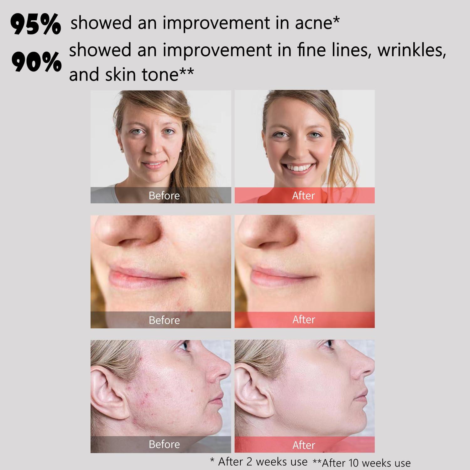 Máscara Facial LED Aphrona Halo para Acné y Arrugas