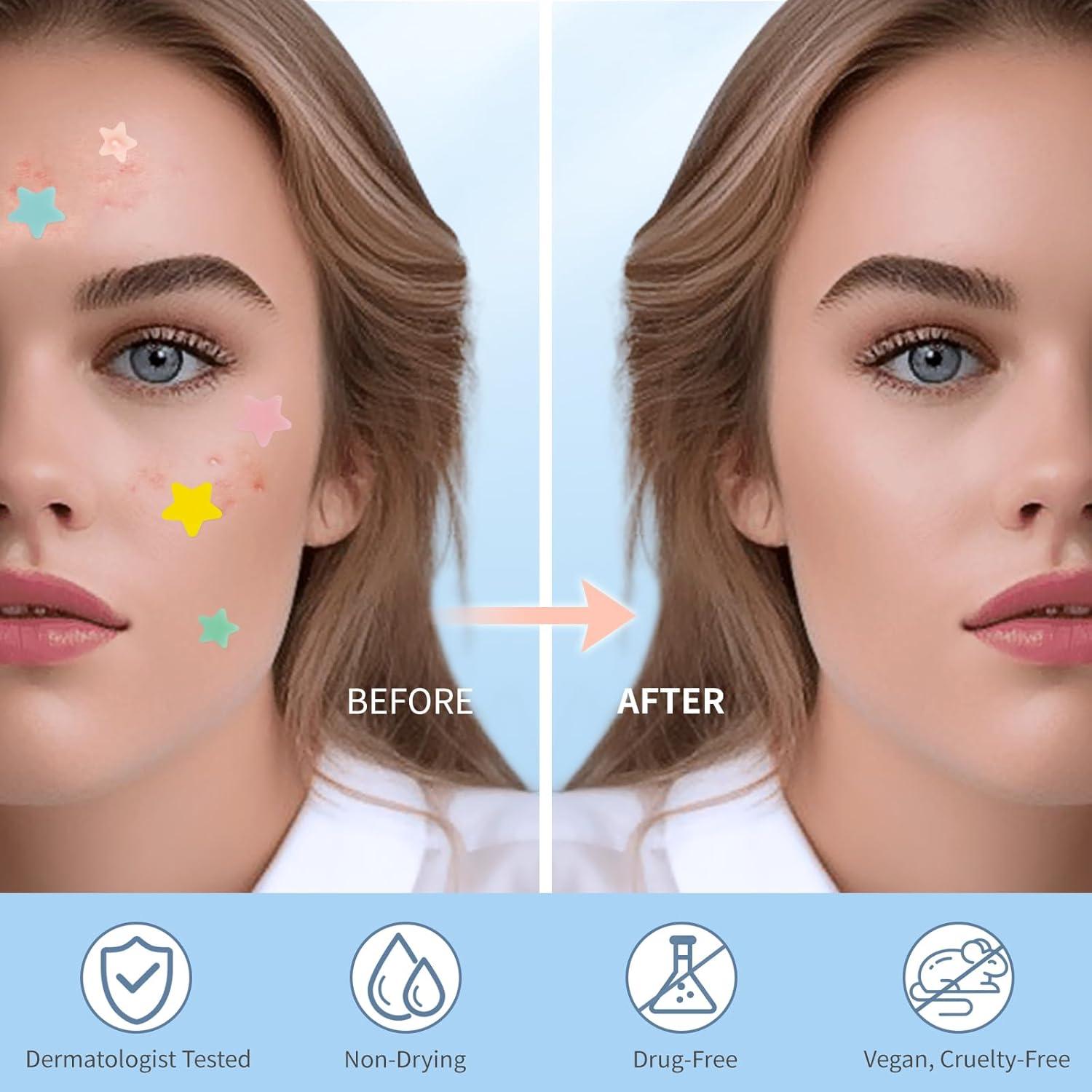 Parche para Granos QUSTERE 200 Unidades Hidrocoloides