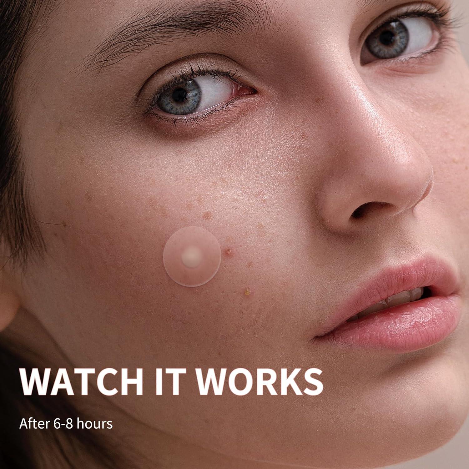 Parche para Granos Daolyo 300 Cuentas Hidrocoloide