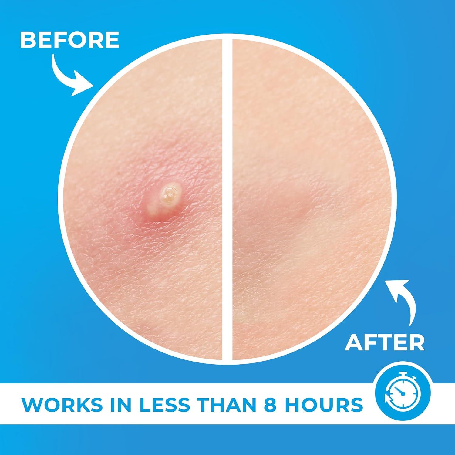 Parches para Granos PatchRx 120 unidades Hidrocoloides