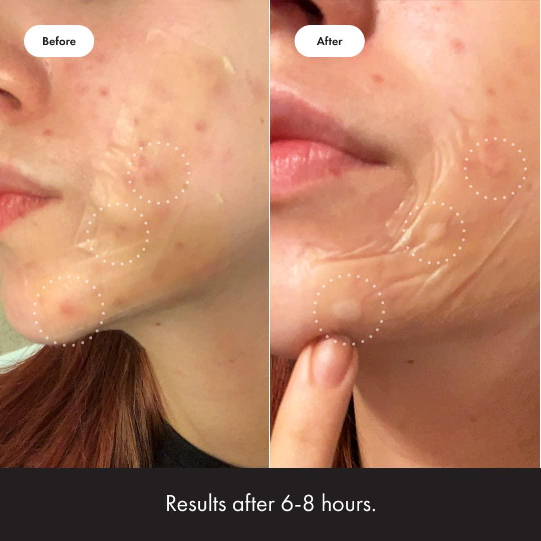 Mighty Patch Surface Hero Cosmetics - Parche acné XL 10 unidades