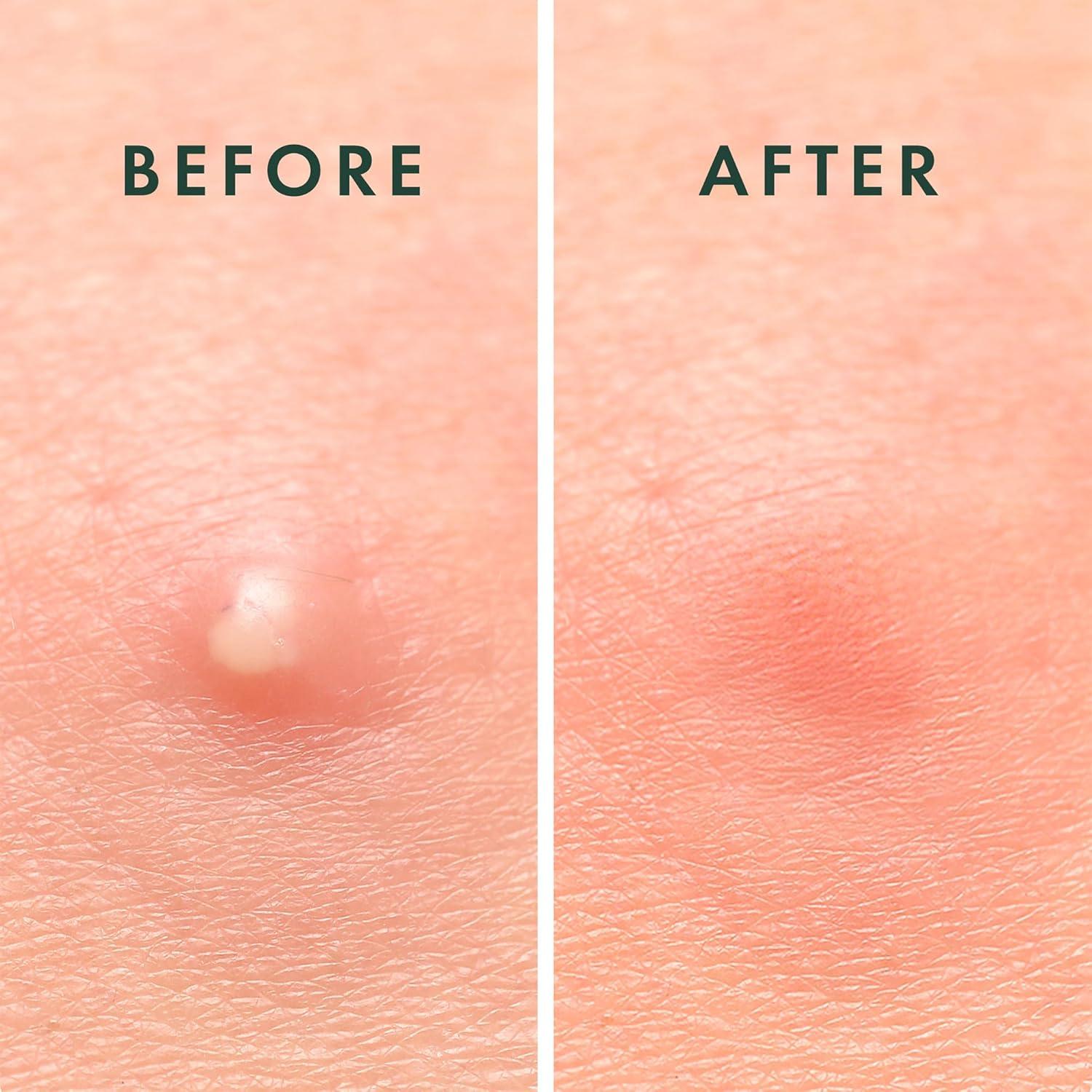 Parche para Granos Rael Invisible 96 Unidades Hidrocoloide