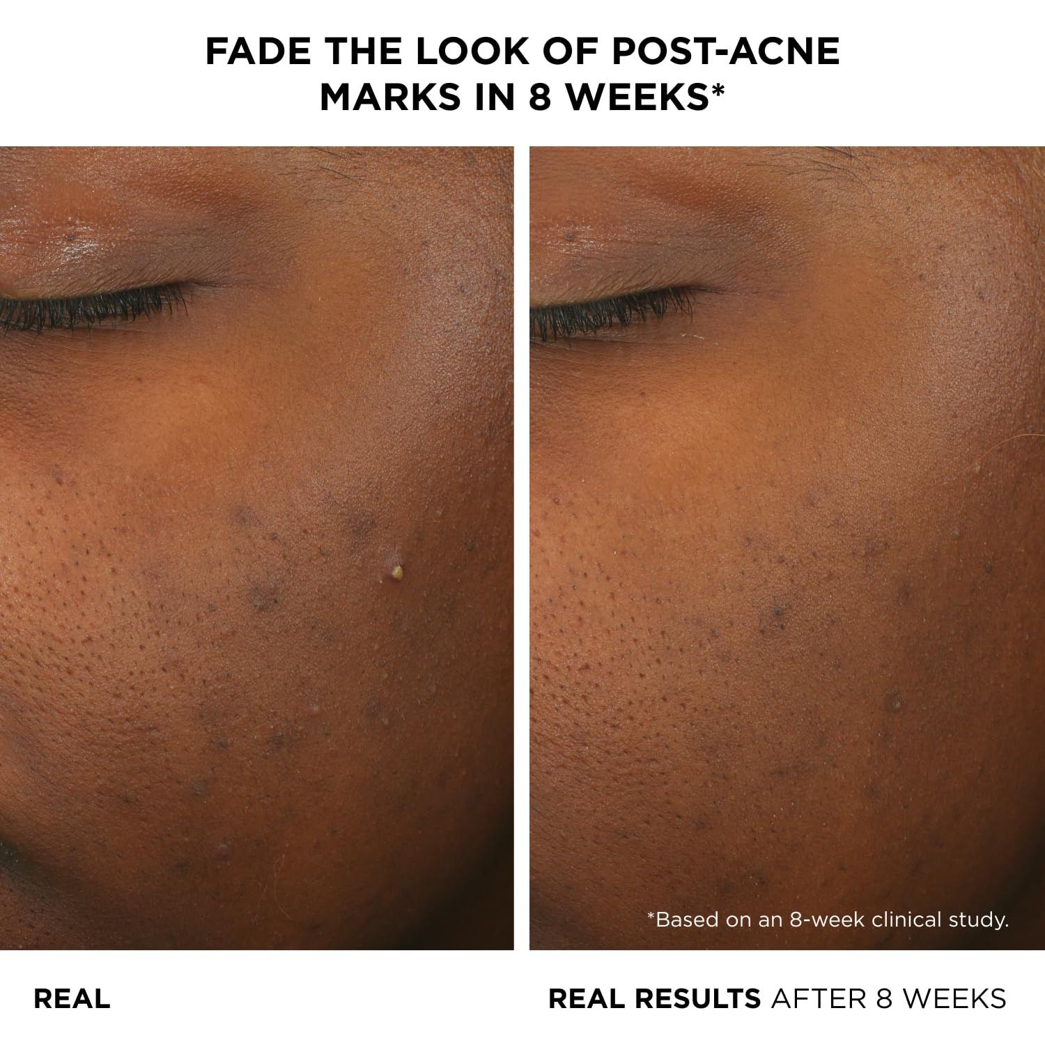 Suero Facial Tratamiento de Acné IT Cosmetics 29.57 ml