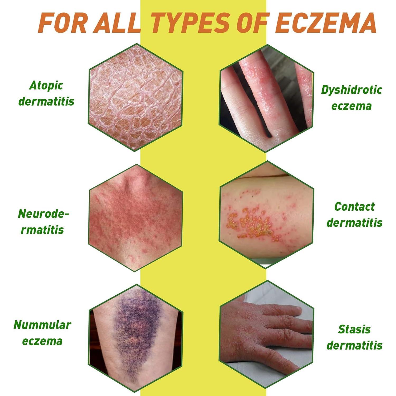 Crema de Veneno de Abeja DUBOONAIO para Eccema y Psoriasis 113g