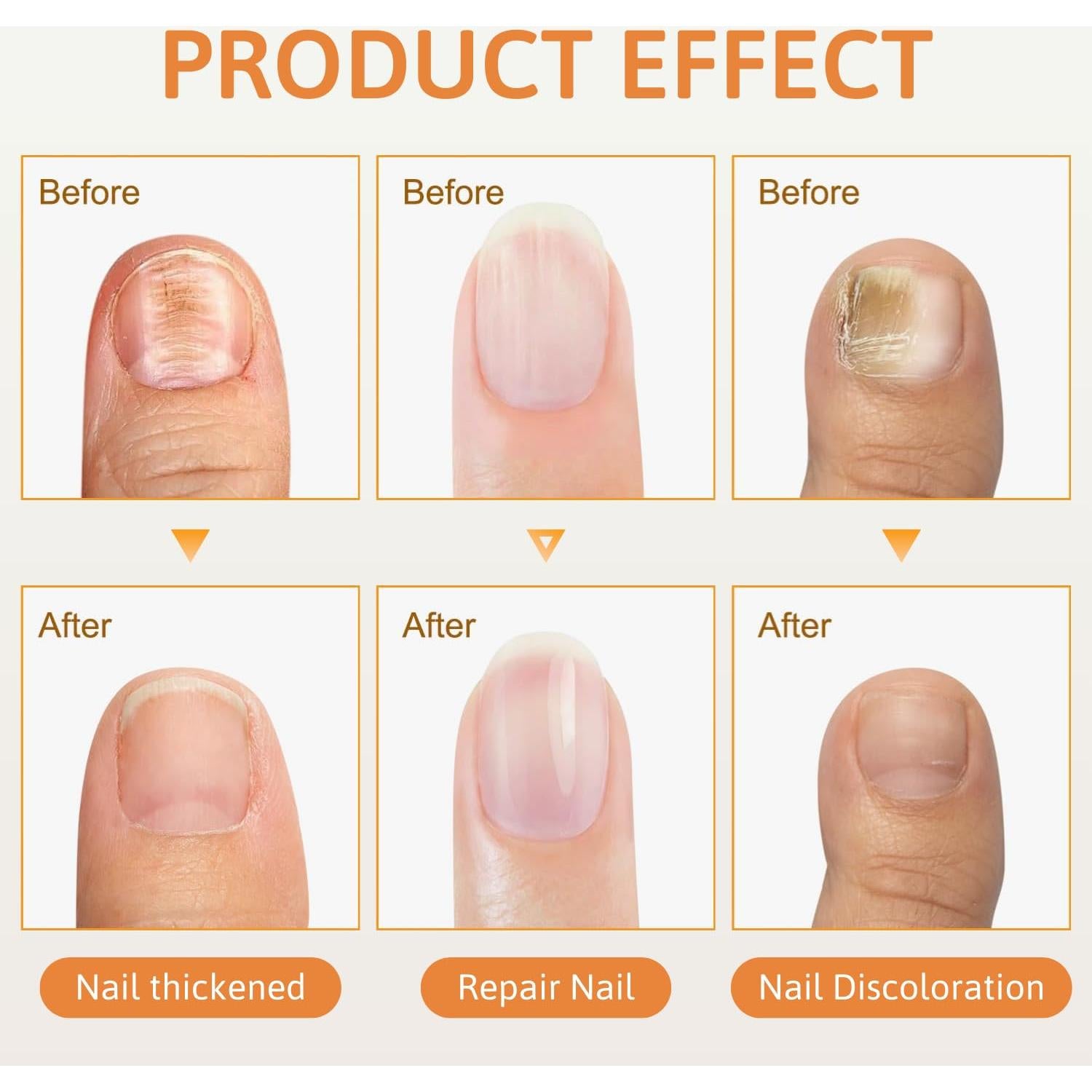 Spray Calmante de Veneno de Abeja para Uñas HHnian 2 Pcs