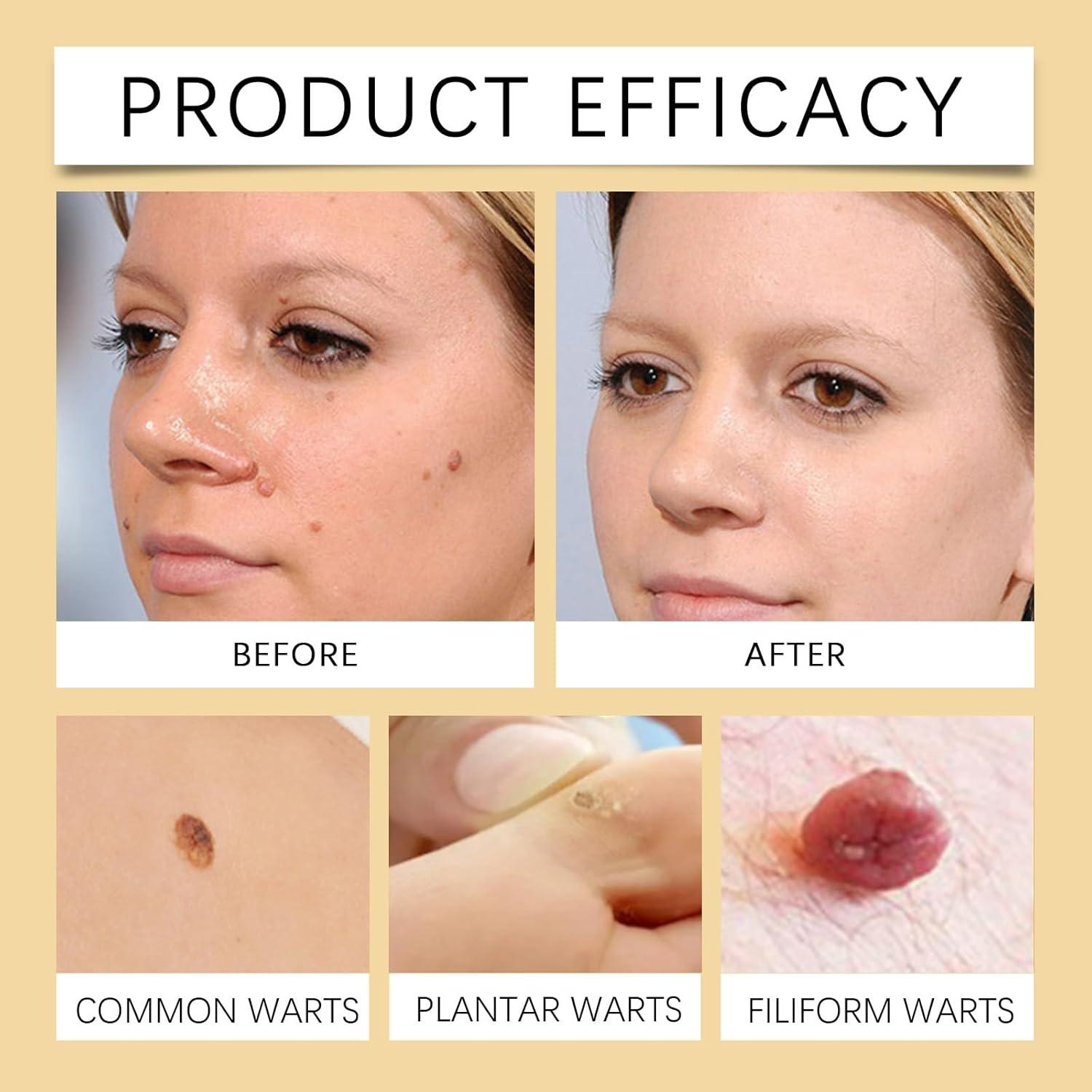 Crema para Verrugas MORKORIA con Veneno de Abeja 30g