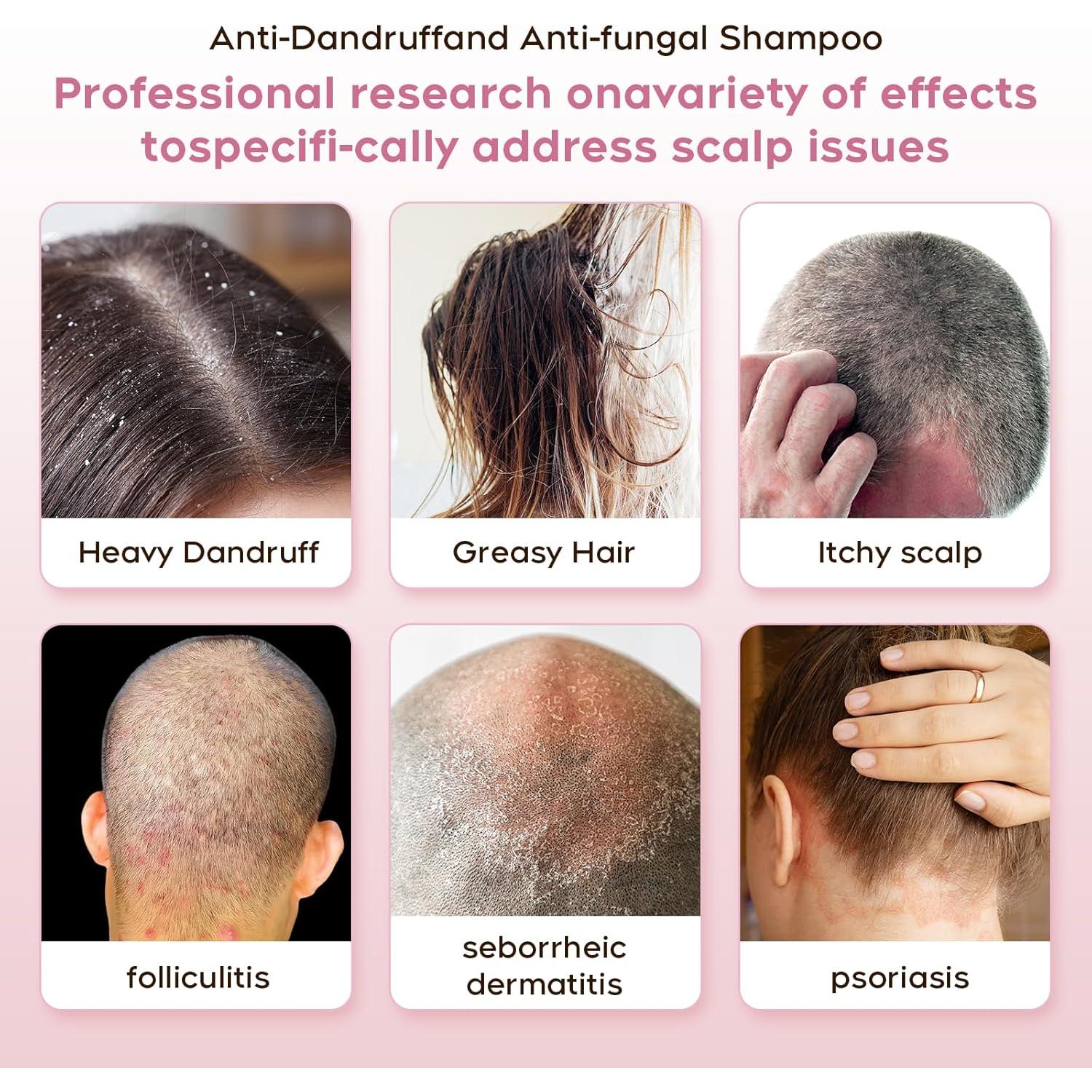 Champú Antifúngico NEWREY 248 ml - Alivio Picazón y Caspa