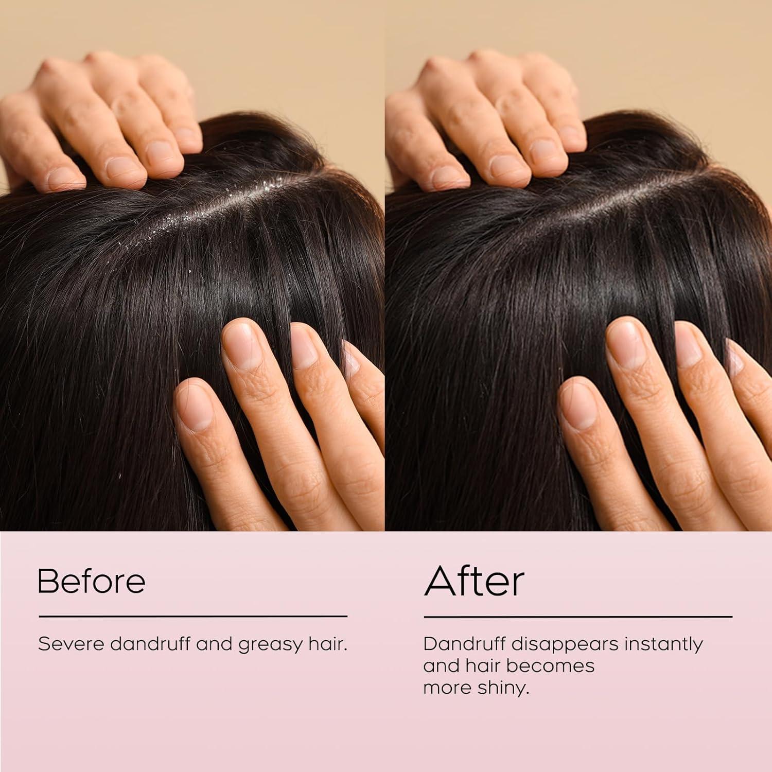 Champú Antifúngico NEWREY 248 ml - Alivio Picazón y Caspa