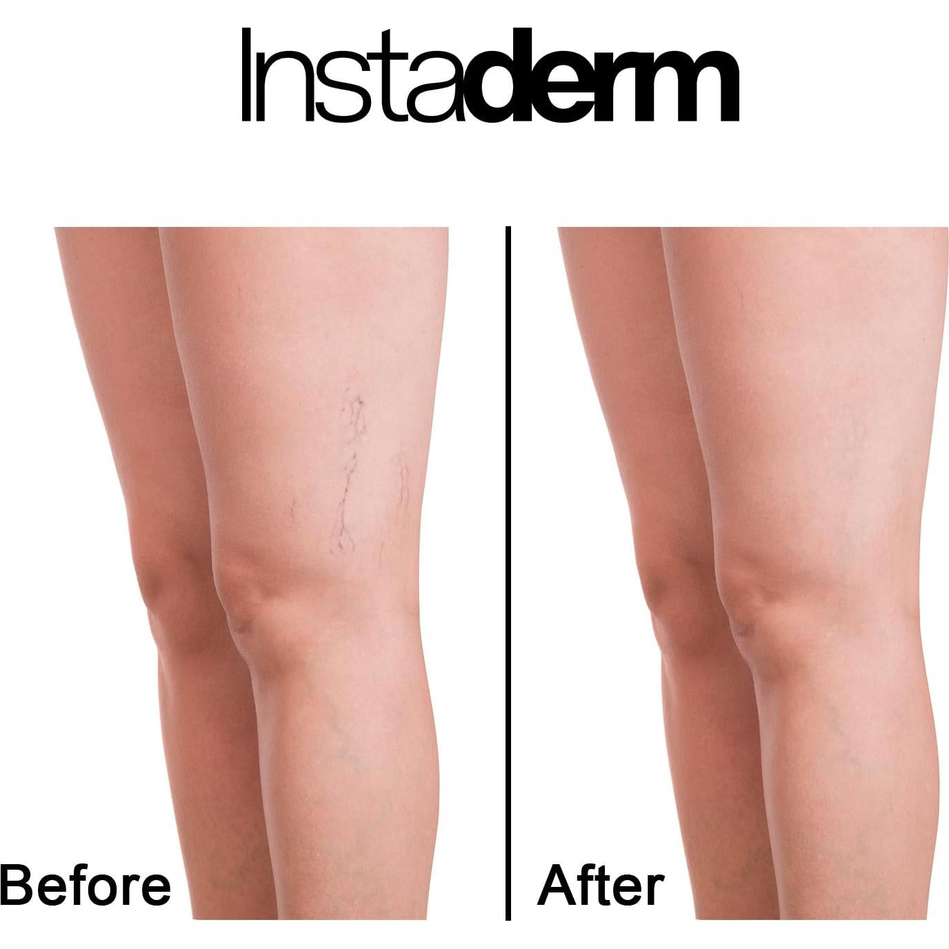 Crema de Vitamina K Instaderm 149g - Hidratante para Moretones