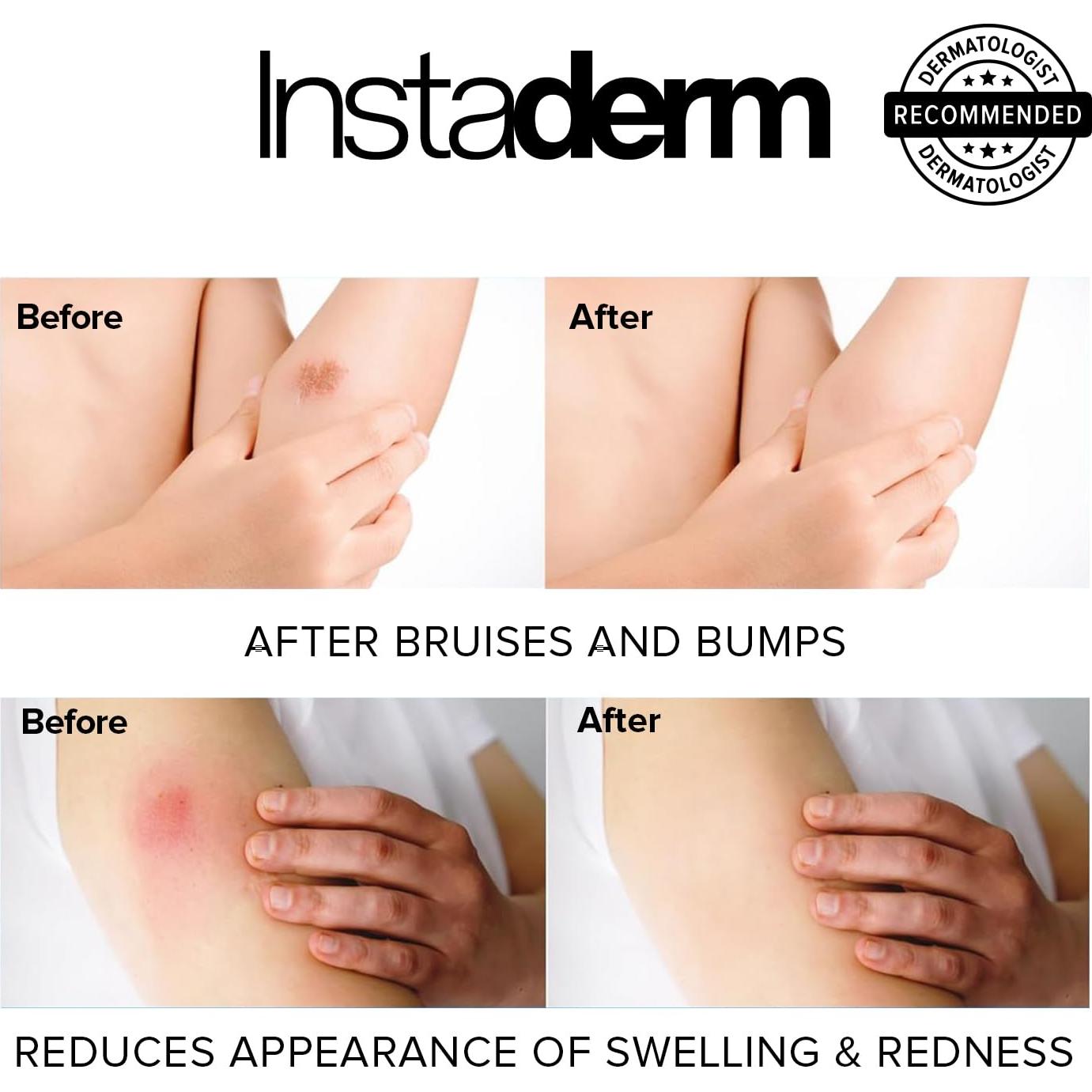 Crema de Vitamina K Instaderm 149g - Hidratante para Moretones