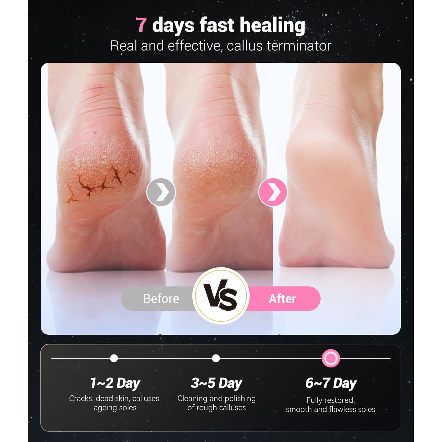 Removedor de Callos Eléctrico Juxujoin 5 en 1 Rosa