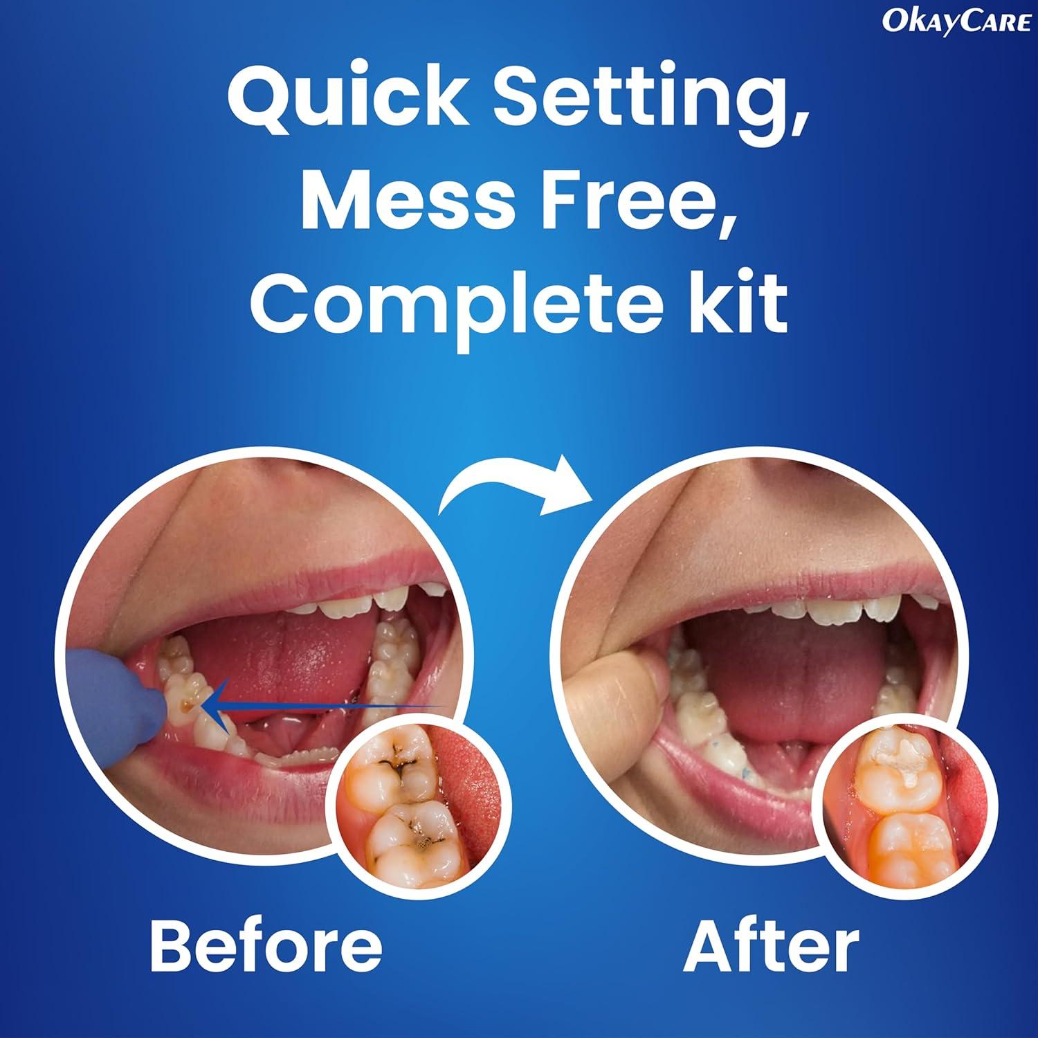 Cemento Dental de Óxido de Zinc Eugenol - Kit Reparación 15ml