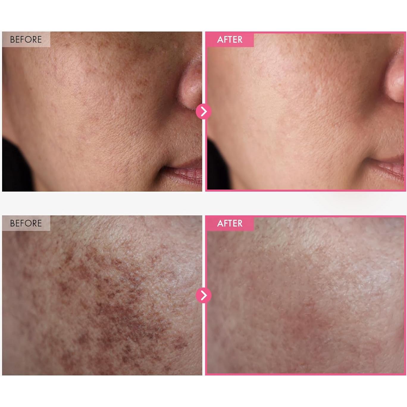 Crema Arbutina 7% + Ácido Tranexámico 4% 50ml Cuidado Piel