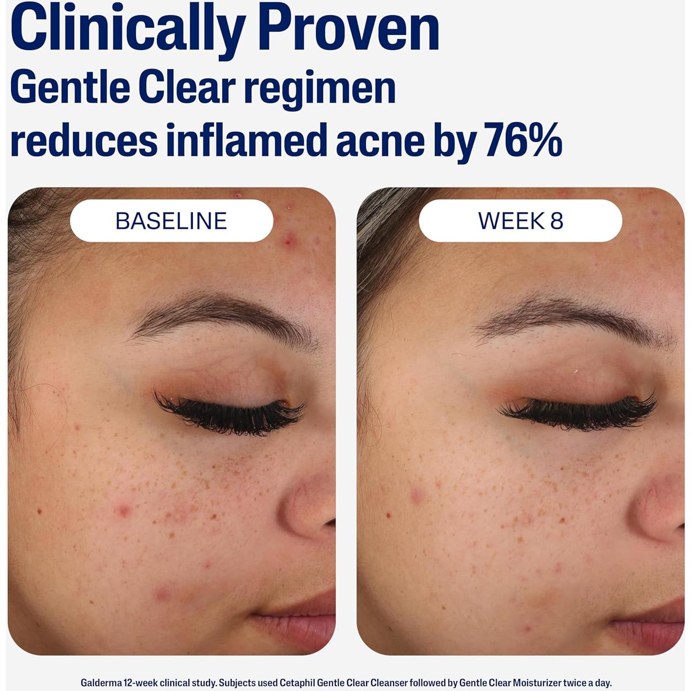 Hidratante Facial Cetaphil 85 g Matificante para Acné