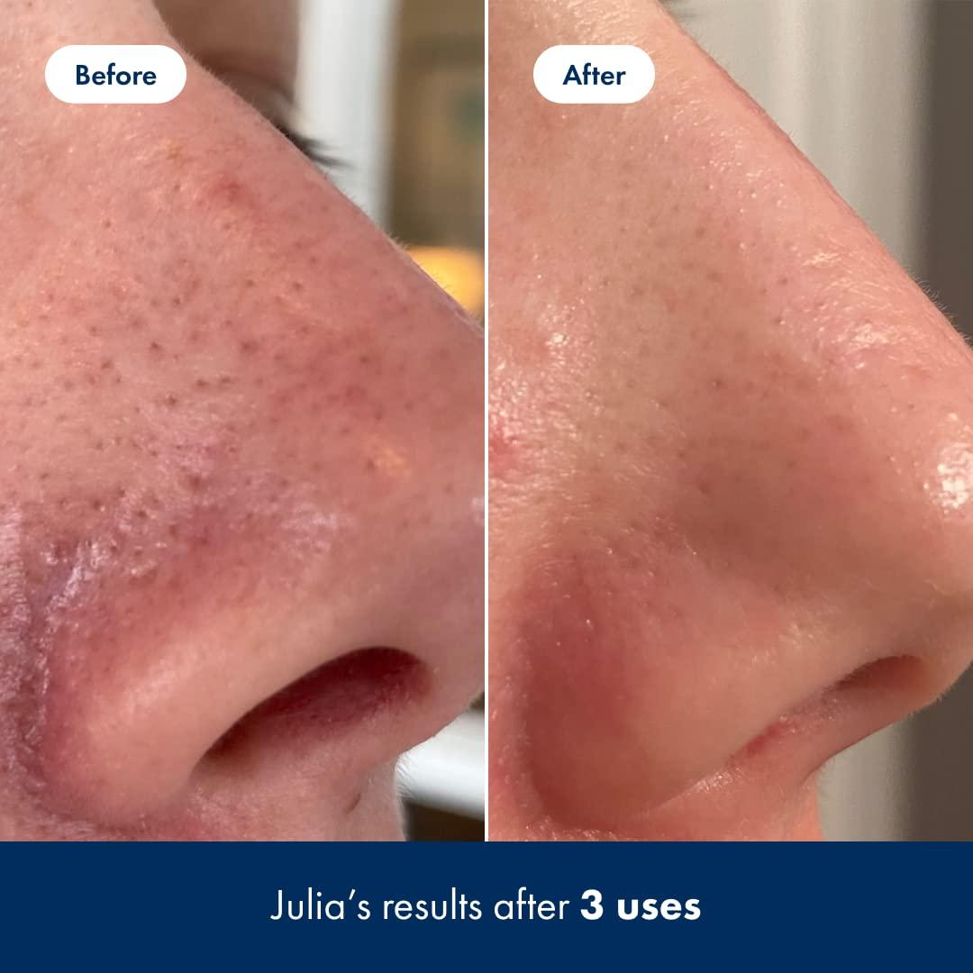 Tónico Exfoliante Hero Cosmetics 100 ml con Ácido Salicílico