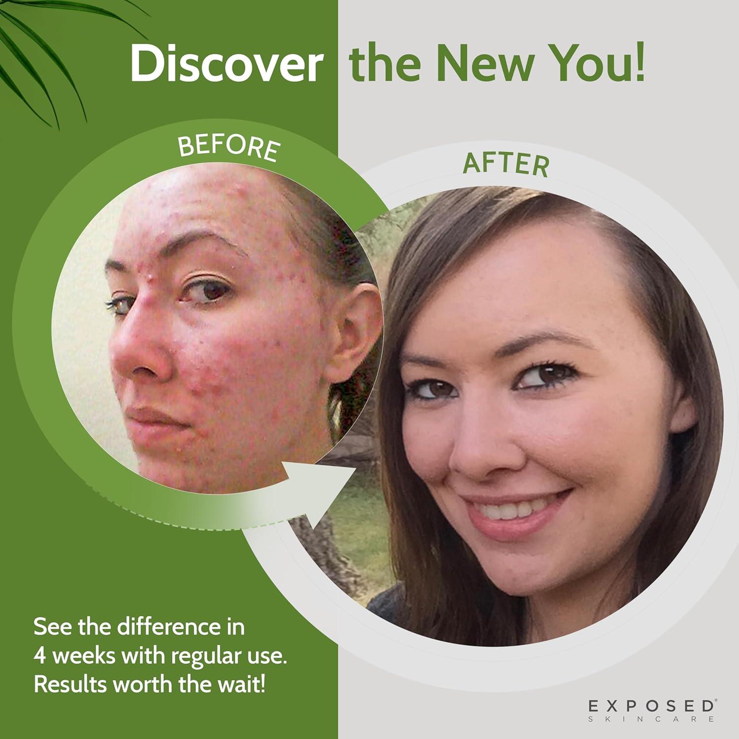 Kit Tratamiento Acné Exposed Skin Care - 5 Piezas Efectivas