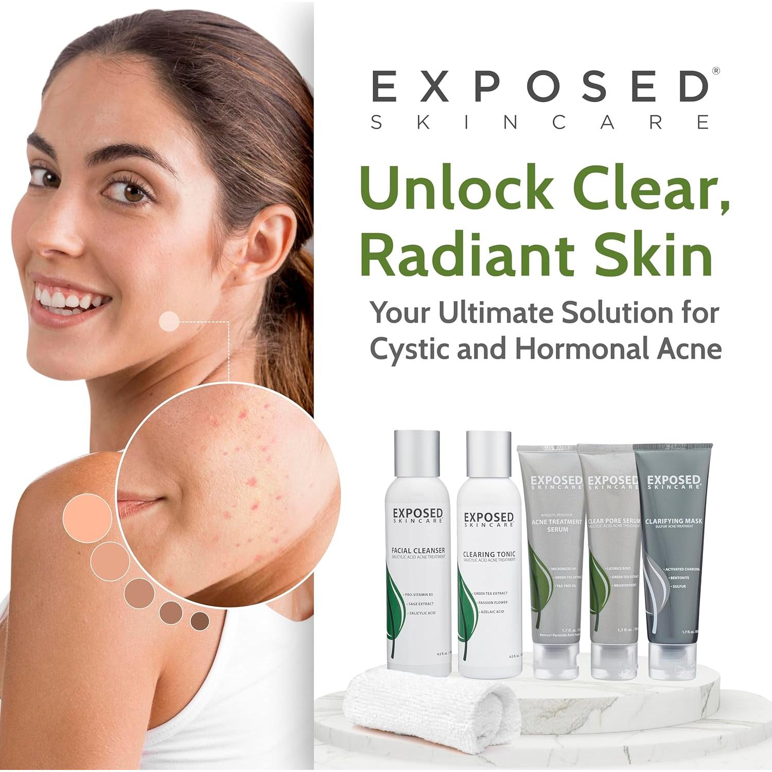 Kit Tratamiento Acné Exposed Skin Care - 5 Piezas Efectivas