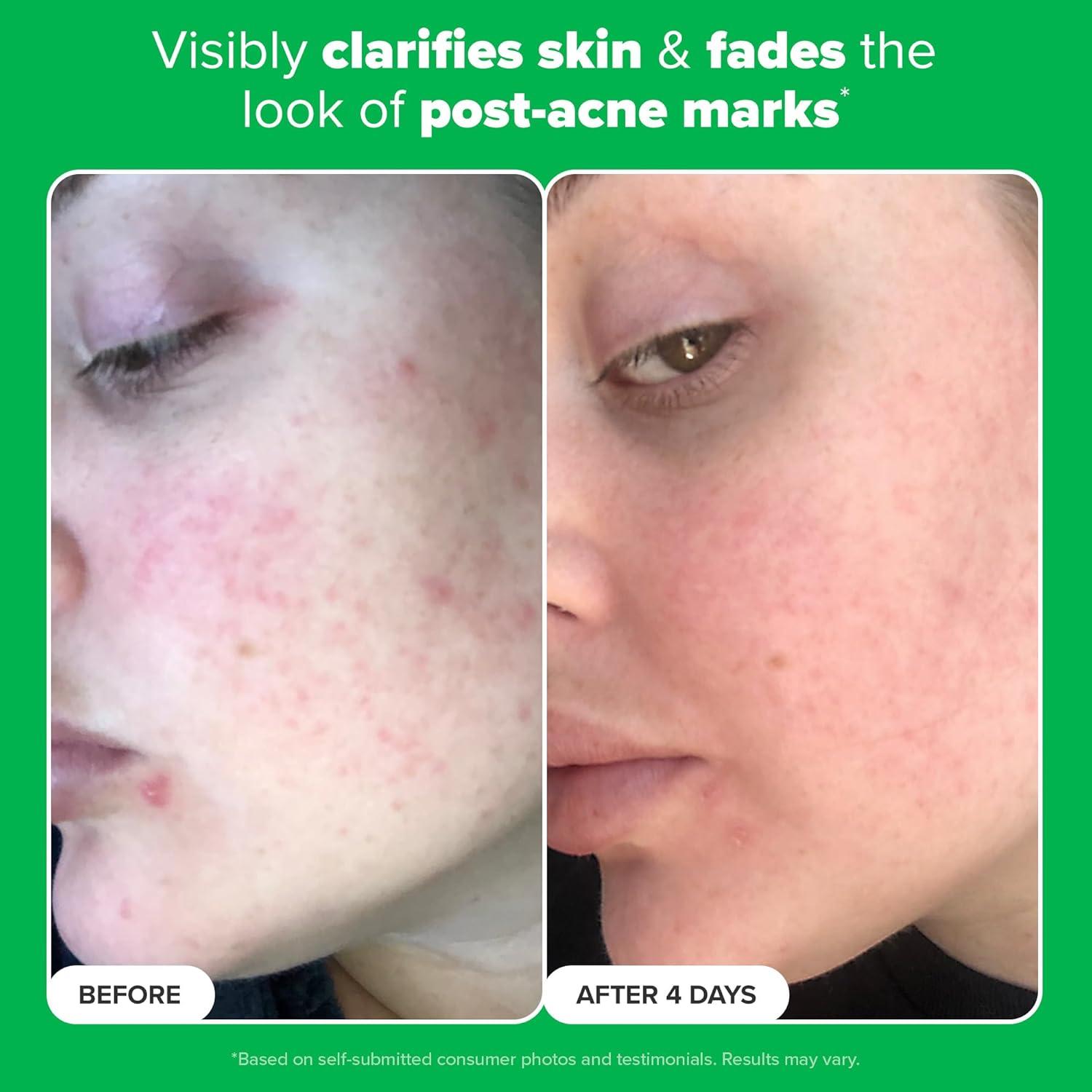 Crema Gel Booster Paula's Choice 10% Ácido Azelaico 28g