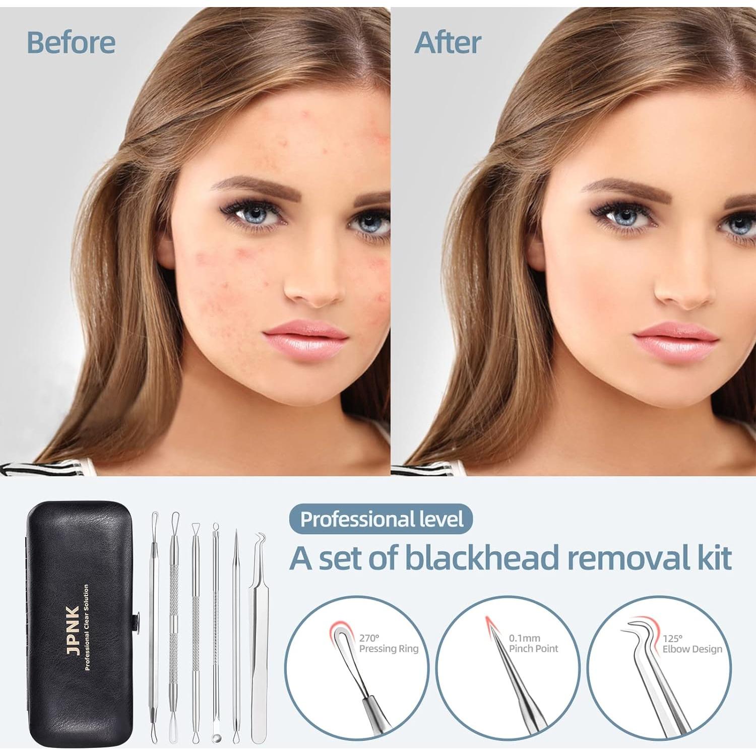 Kit Removedor de Puntos Negros JPNK 6 Piezas Acero Inoxidable