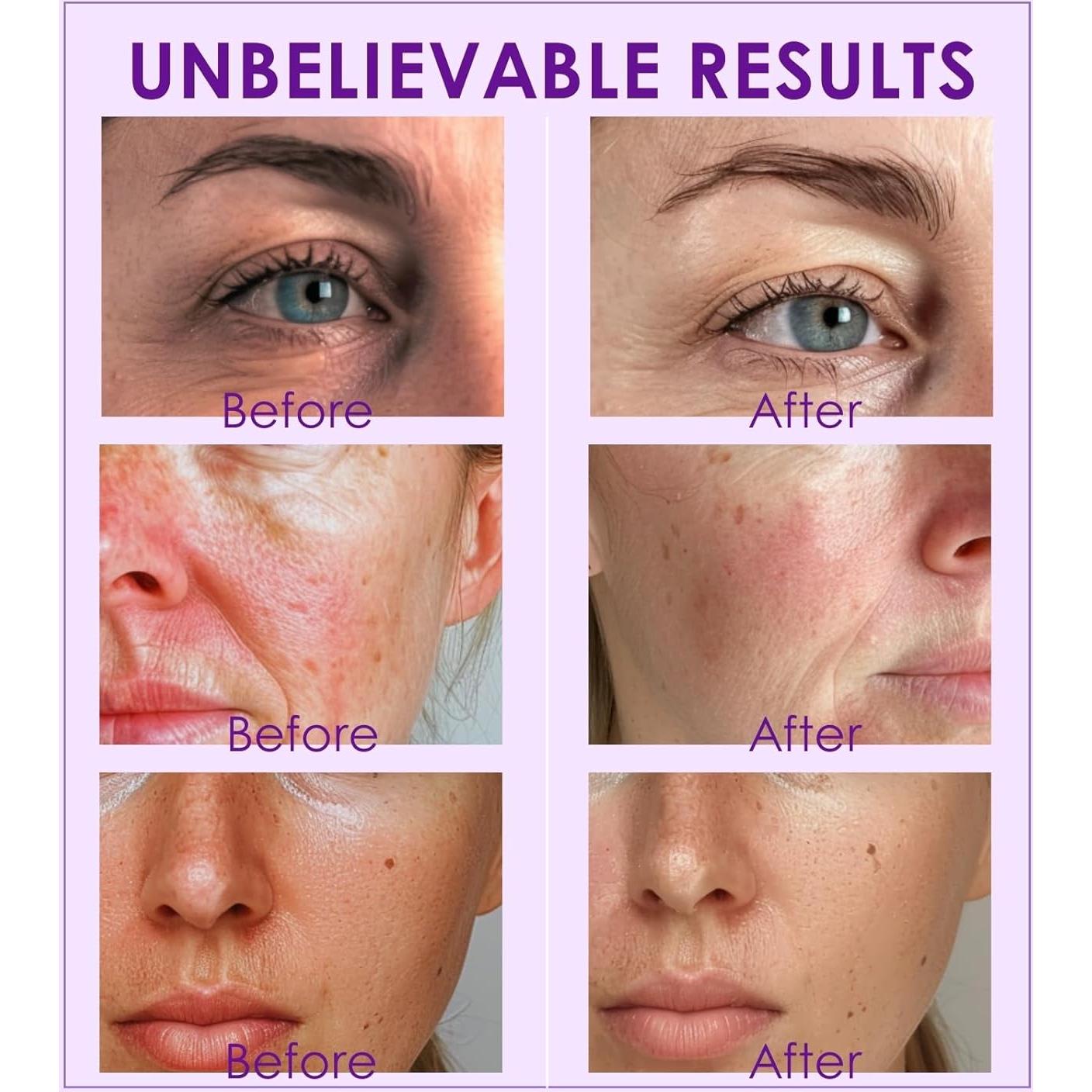 Esferas de Hielo Facial Lazzybeauty ICGMH para Masaje