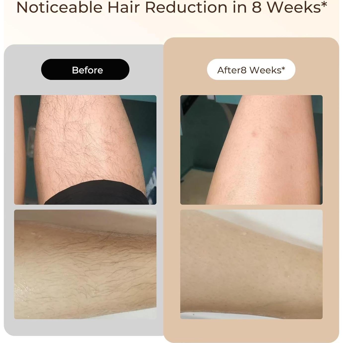 Eliminación de Vello IPL Finequin FZ-200A 9 Niveles Energía