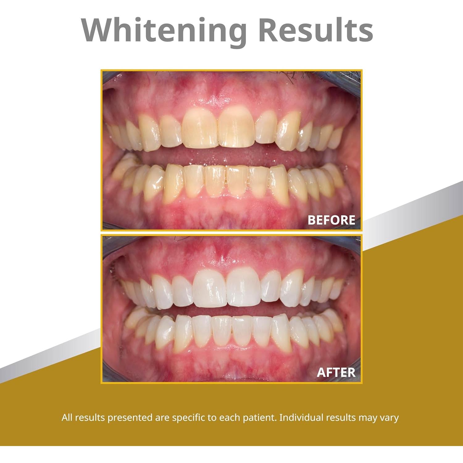 Gel Blanqueador Dental Opalescence 45% - 4 Jeringas Menta