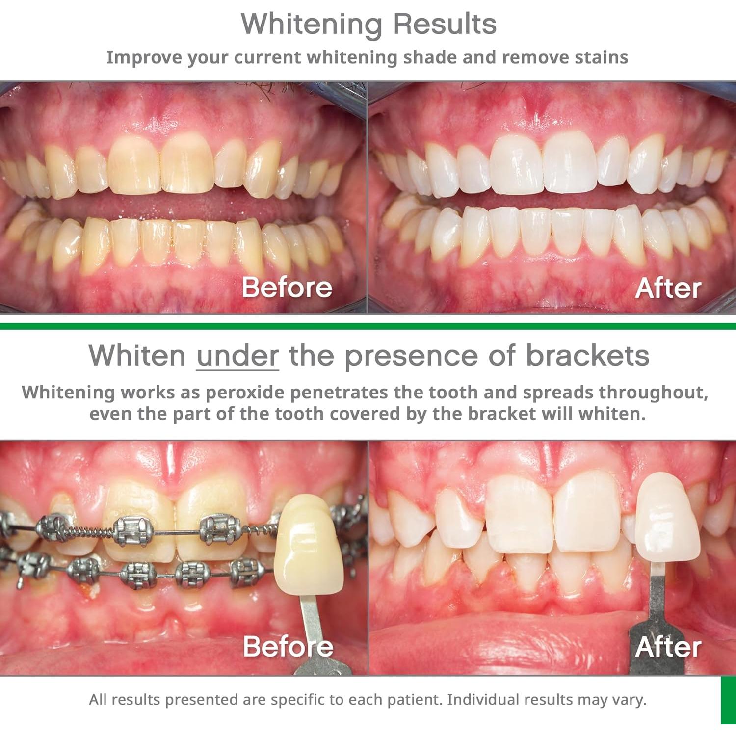 Kit Blanqueamiento Dental Opalescence Go 10% - Menta - 10 Tratamientos