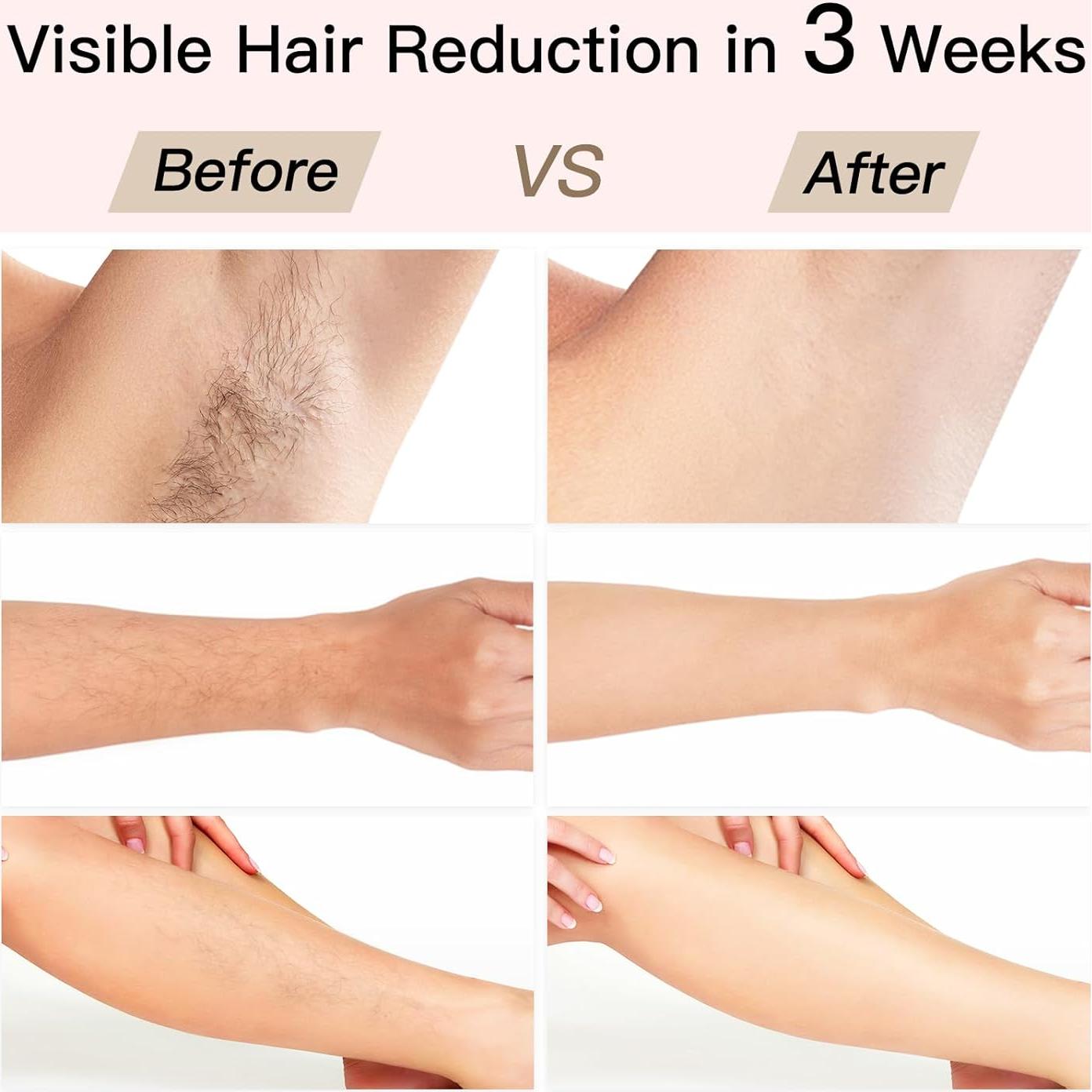 Eliminación de Vello Láser BoSidin IPL Indoloro 6 Modos